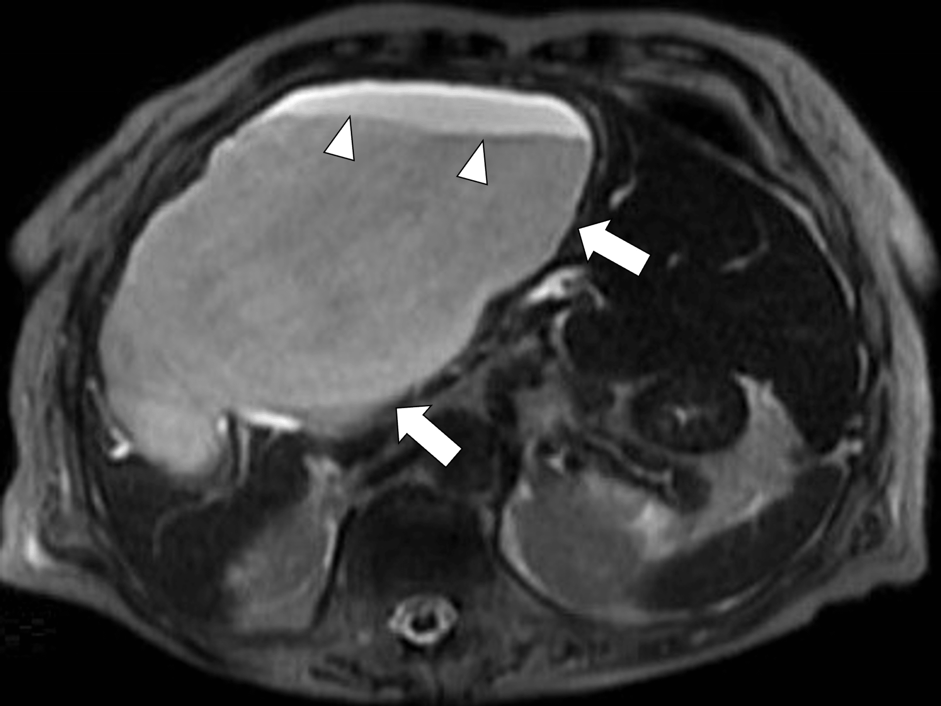 Cureus Diagnosing Infectious Hepatic Cysts in an Older Patient With