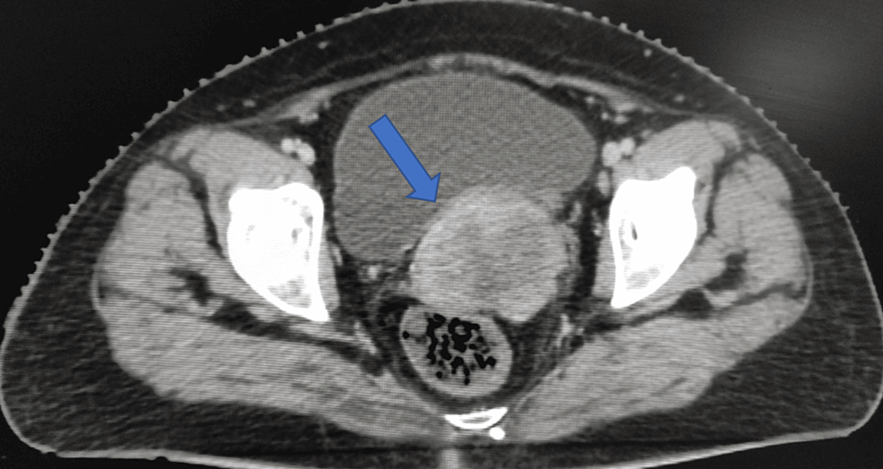 cureus-cutaneous-metastasis-in-a-treated-case-of-cervical-cancer-with