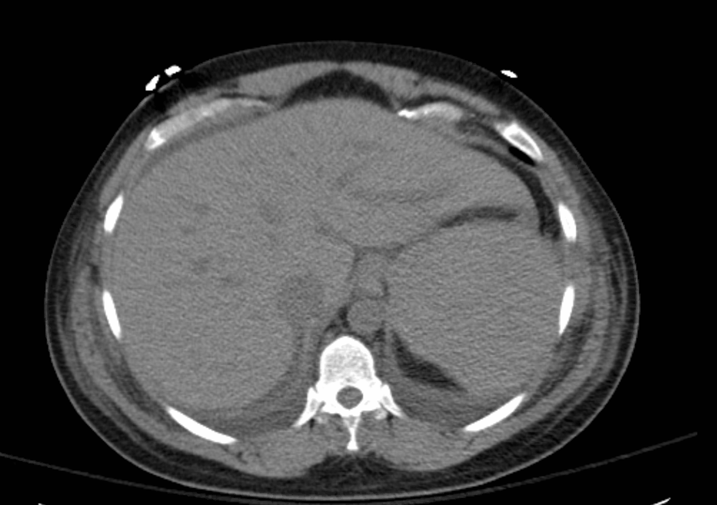 Role of Plasmapheresis in Hemolysis, Elevated Liver Enzymes and Low