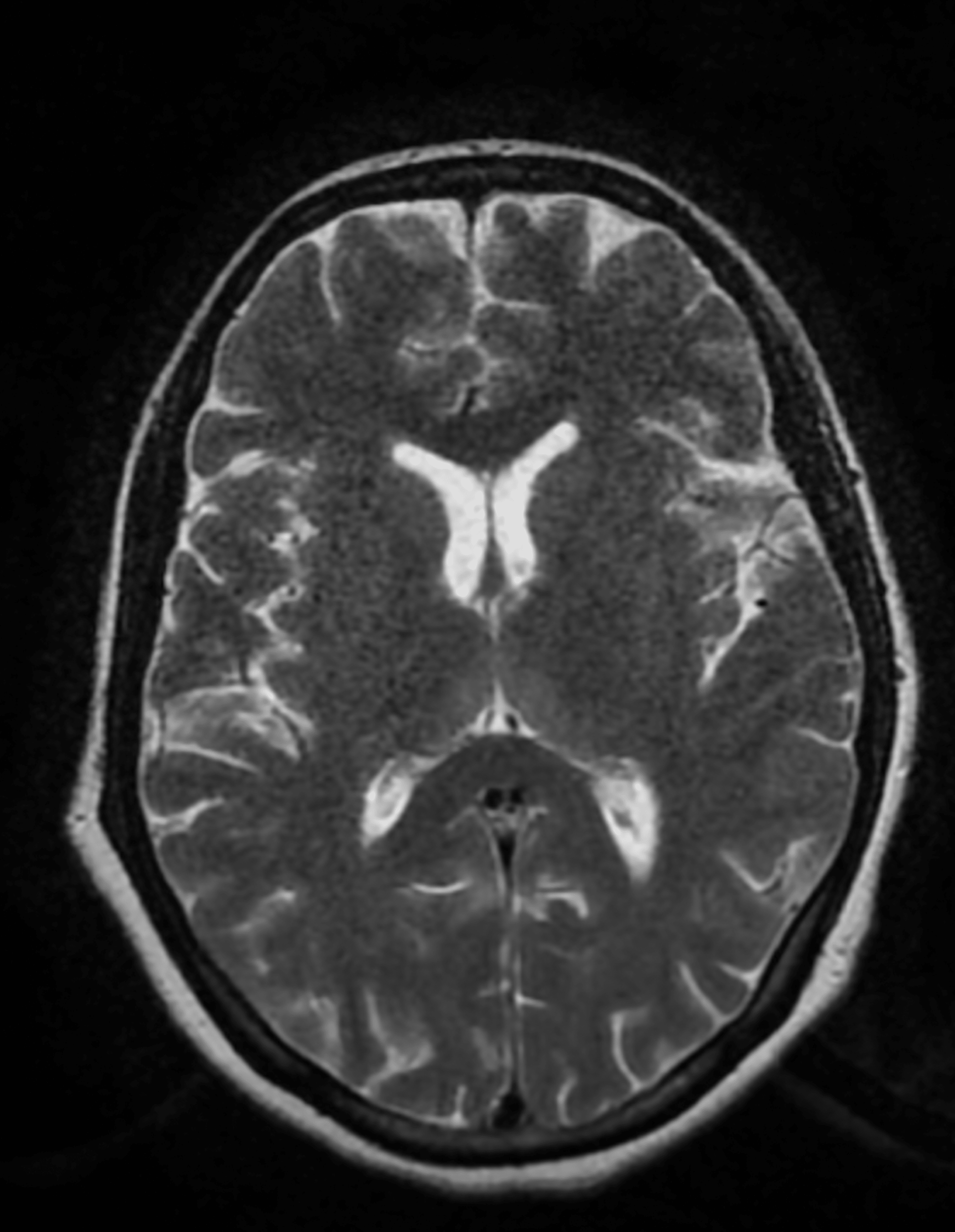 Unveiling the Unprecedented An Astonishing Rarity of Metoclopramide