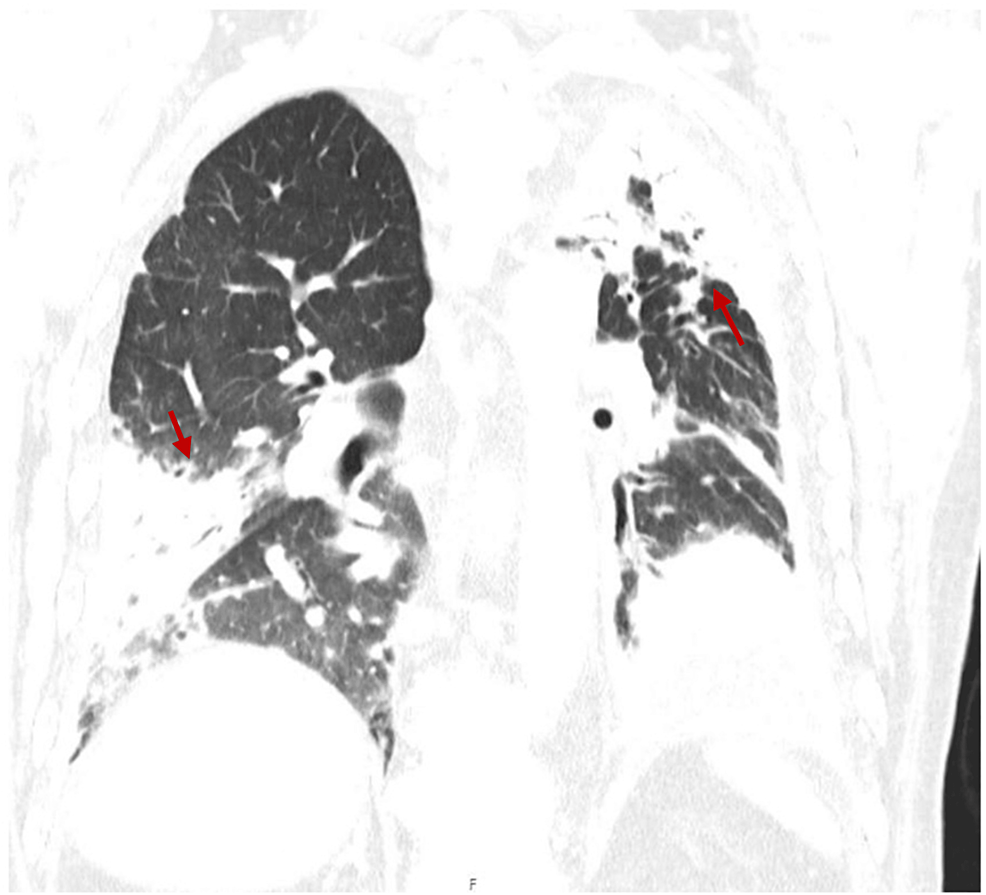 lung-and-pleural-immunoglobulin-g4-related-disease-two-contrasting