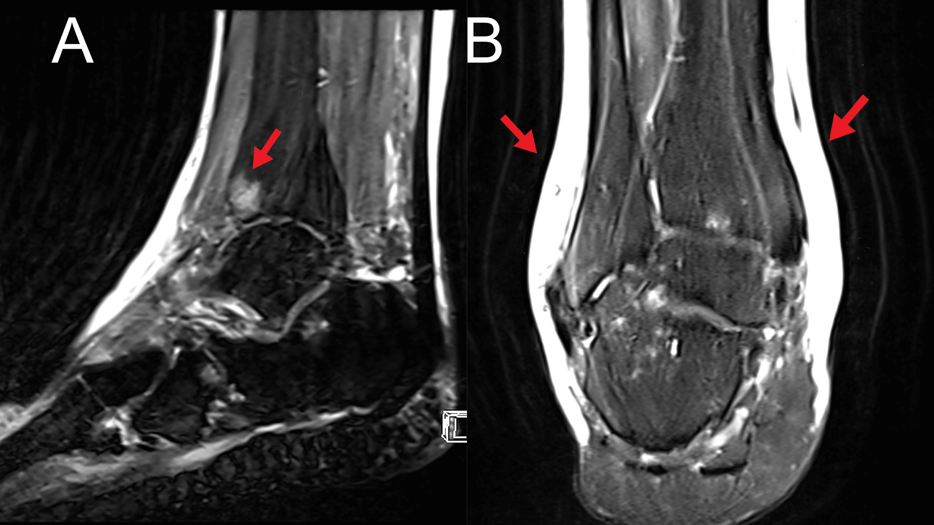 Cureus Bilateral Cellulitis Presented As LowerExtremity Pain