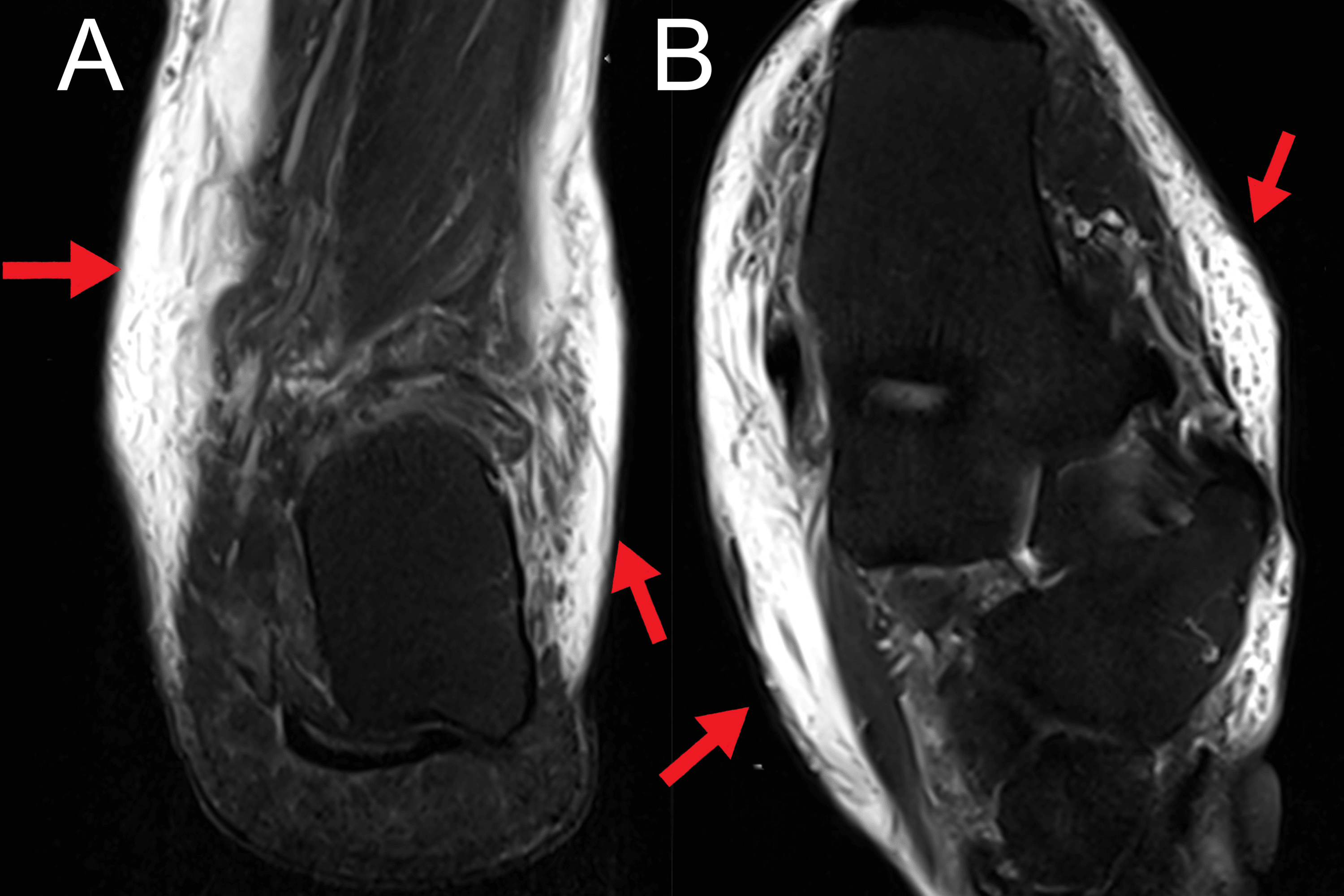Bilateral Cellulitis Presented As LowerExtremity Pain Reported in a