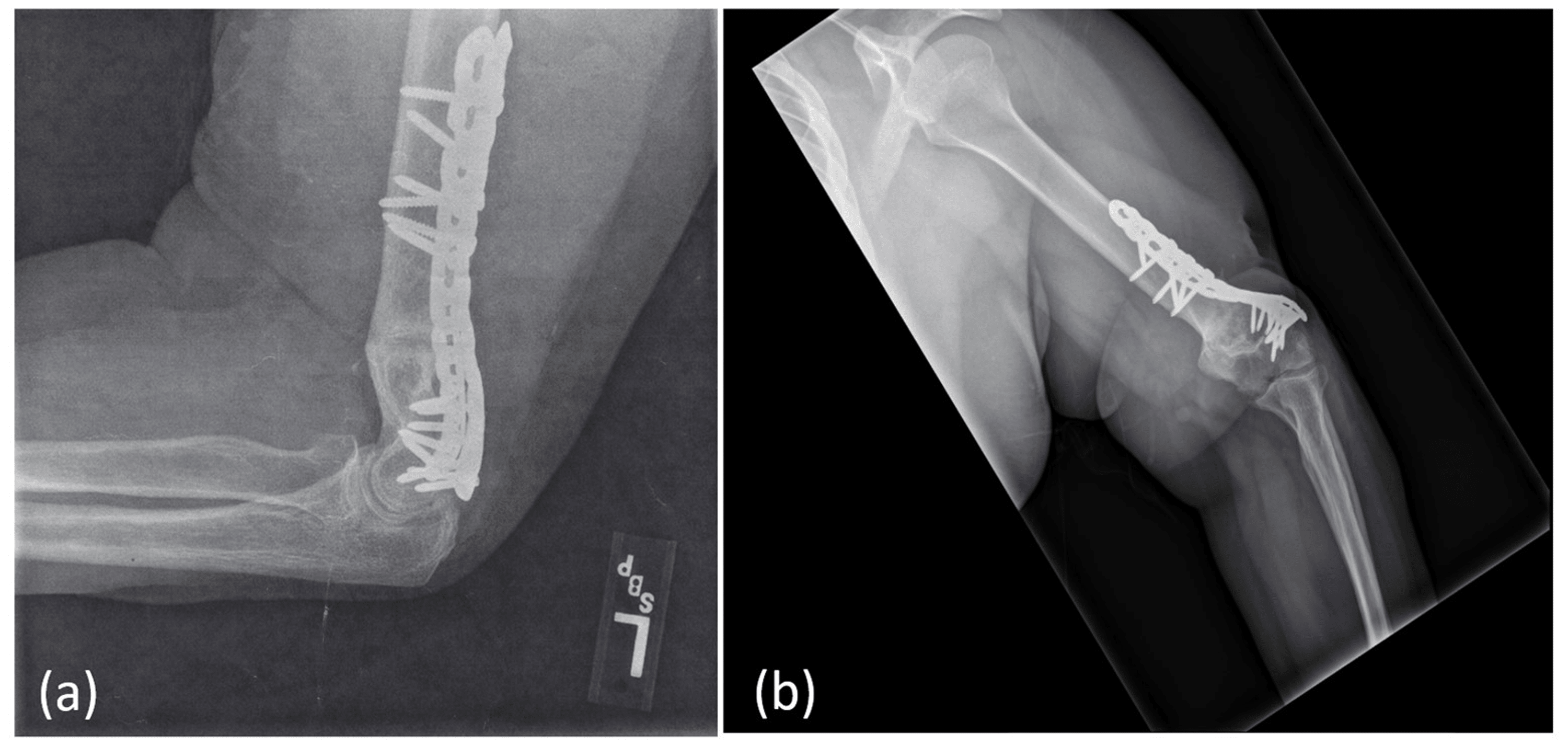 Traumatic Humeral Shaft Nonunion With Ulnar Nerve Transection An