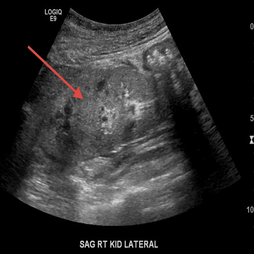 Hydralazine-induced Vasculitis 