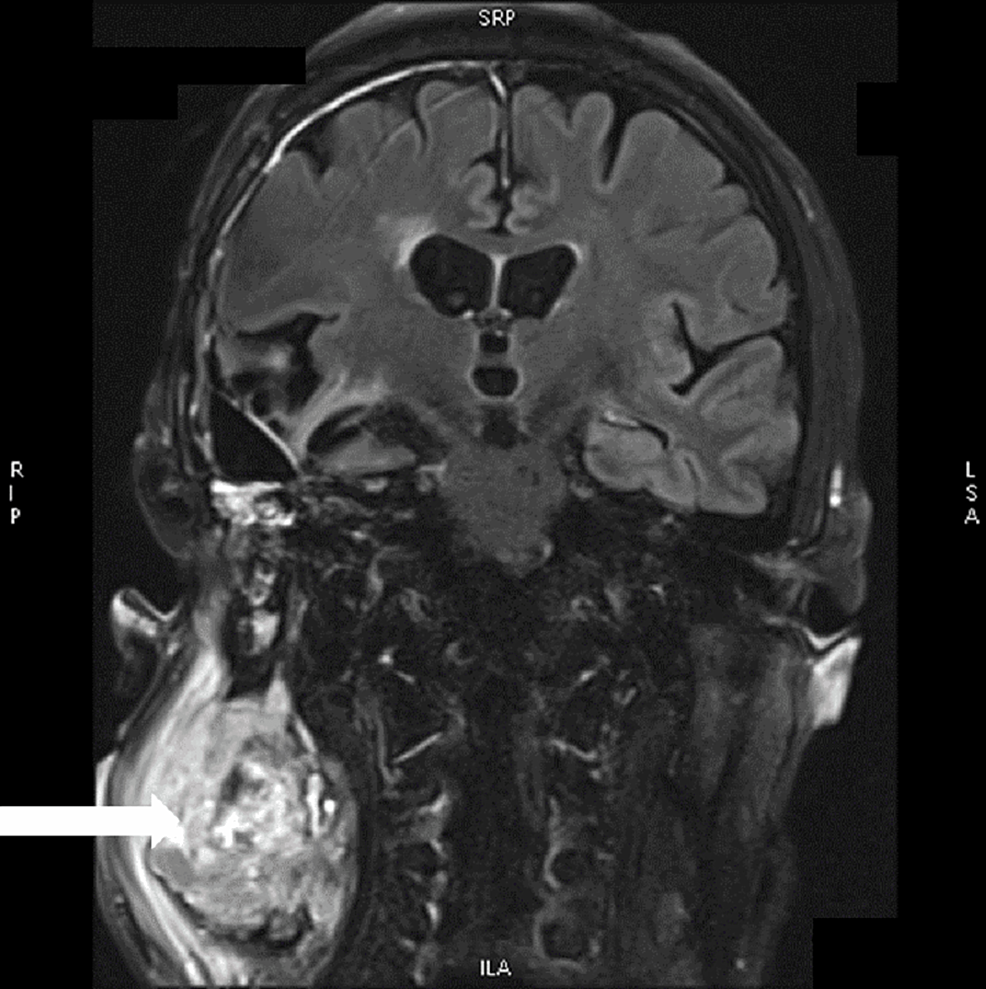 Cureus Extracranial Glioblastoma Metastasis A Neuropathological Case Report 3747