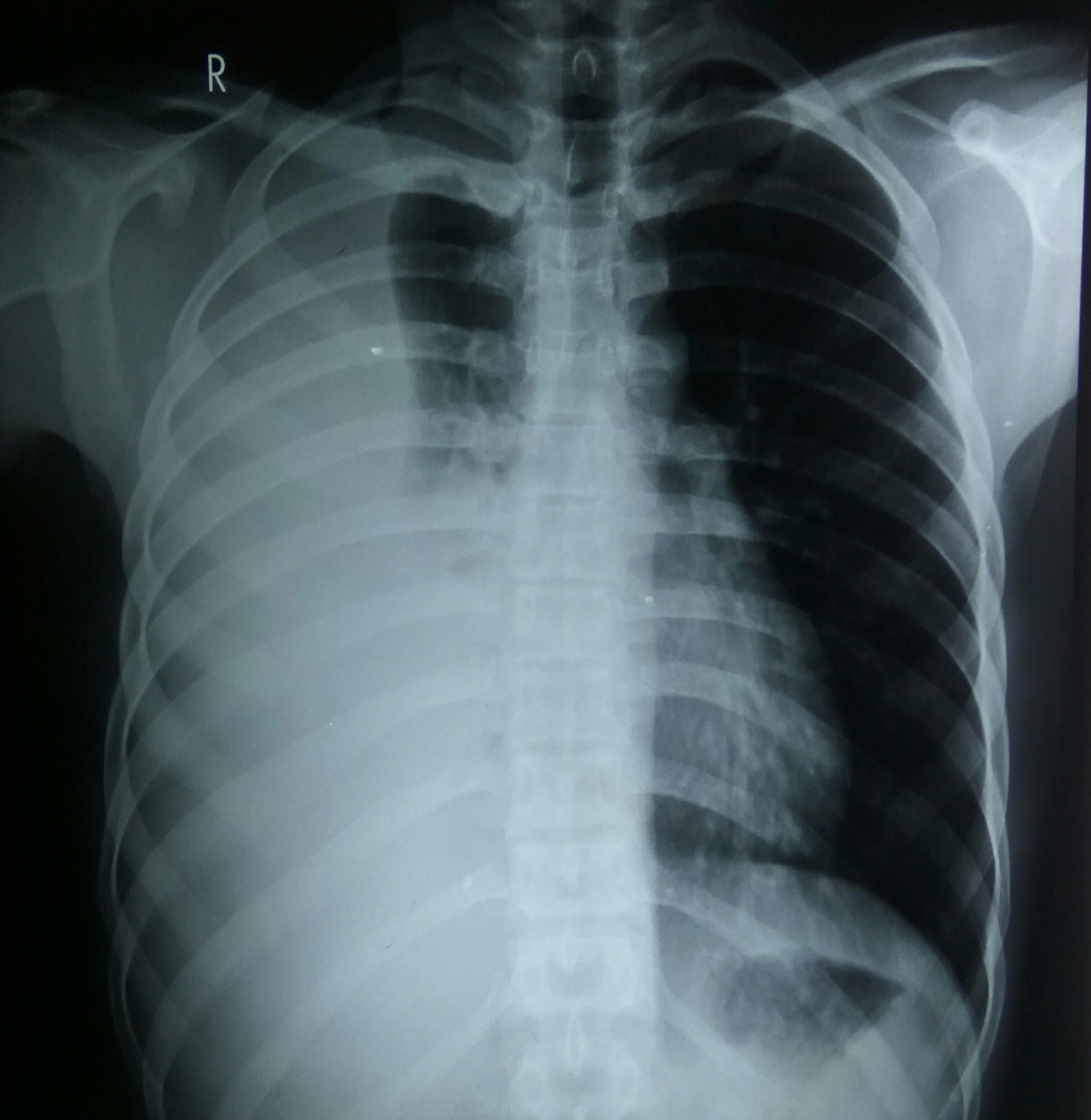 Cureus Idiopathic Eosinophilic Pleural Effusion Treated Successfully