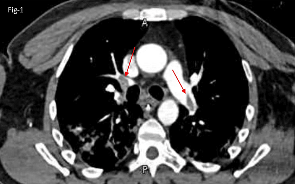 To study the correlation between clinical severity and cytokine storm in patients with COVID-19 pulmonary embolism using …