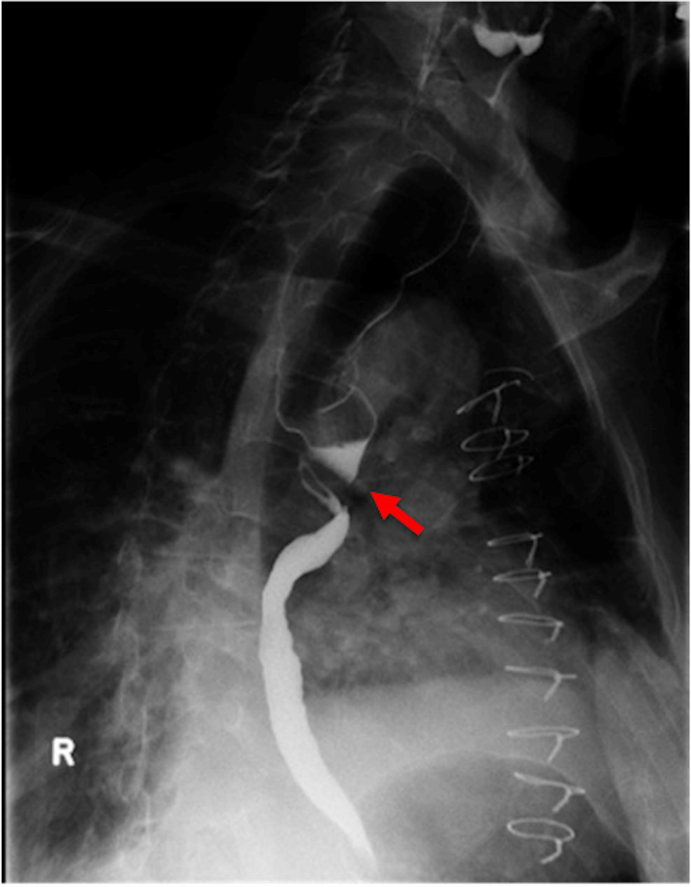 Diffuse Esophageal Spasm Barium Swallow