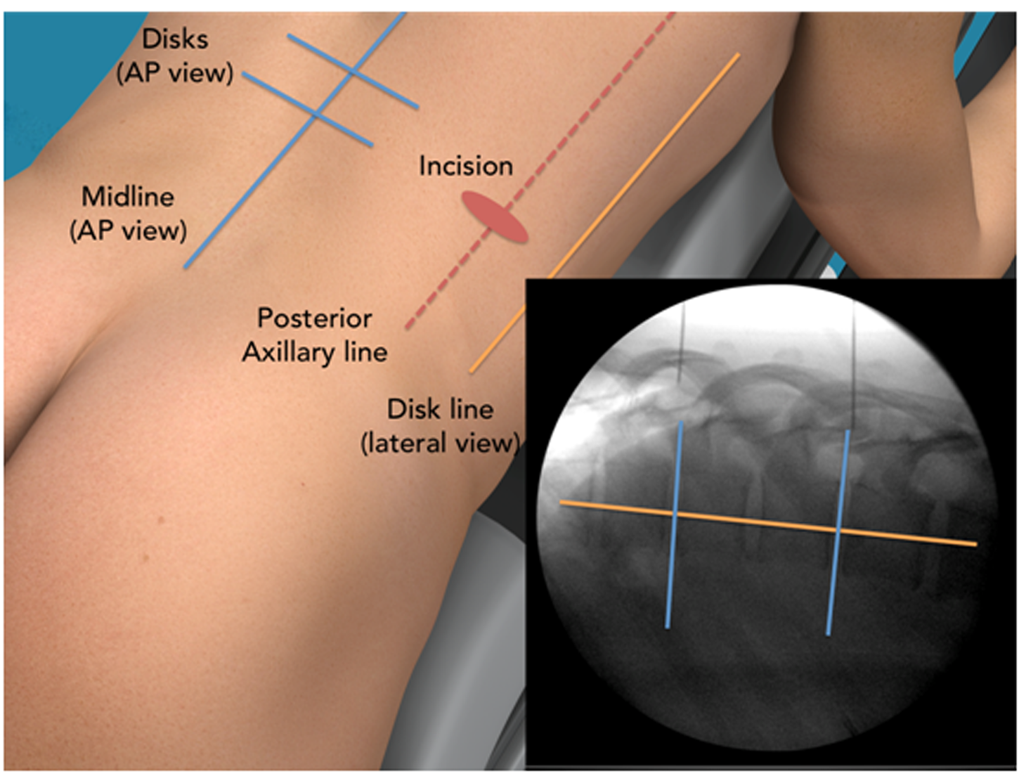 Cureus Minimally Invasive Direct Thoracic Interbody Fusion Mis Dtif Technical Notes Of A