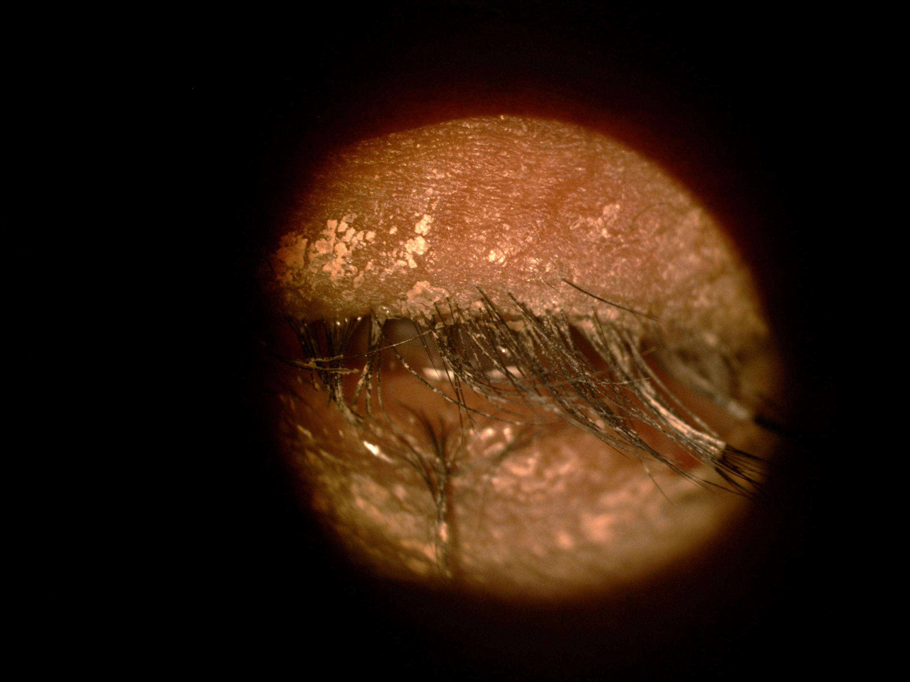 Cureus Ocular Manifestations of EctrodactylyEctodermal Dysplasia