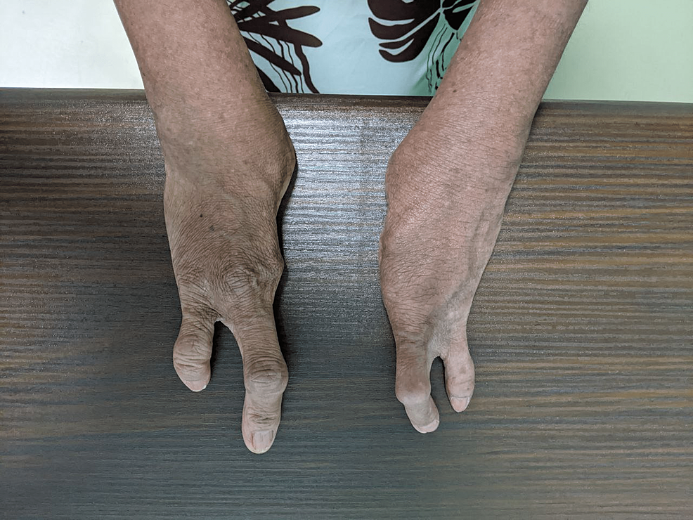 Cureus Ocular Manifestations of EctrodactylyEctodermal Dysplasia