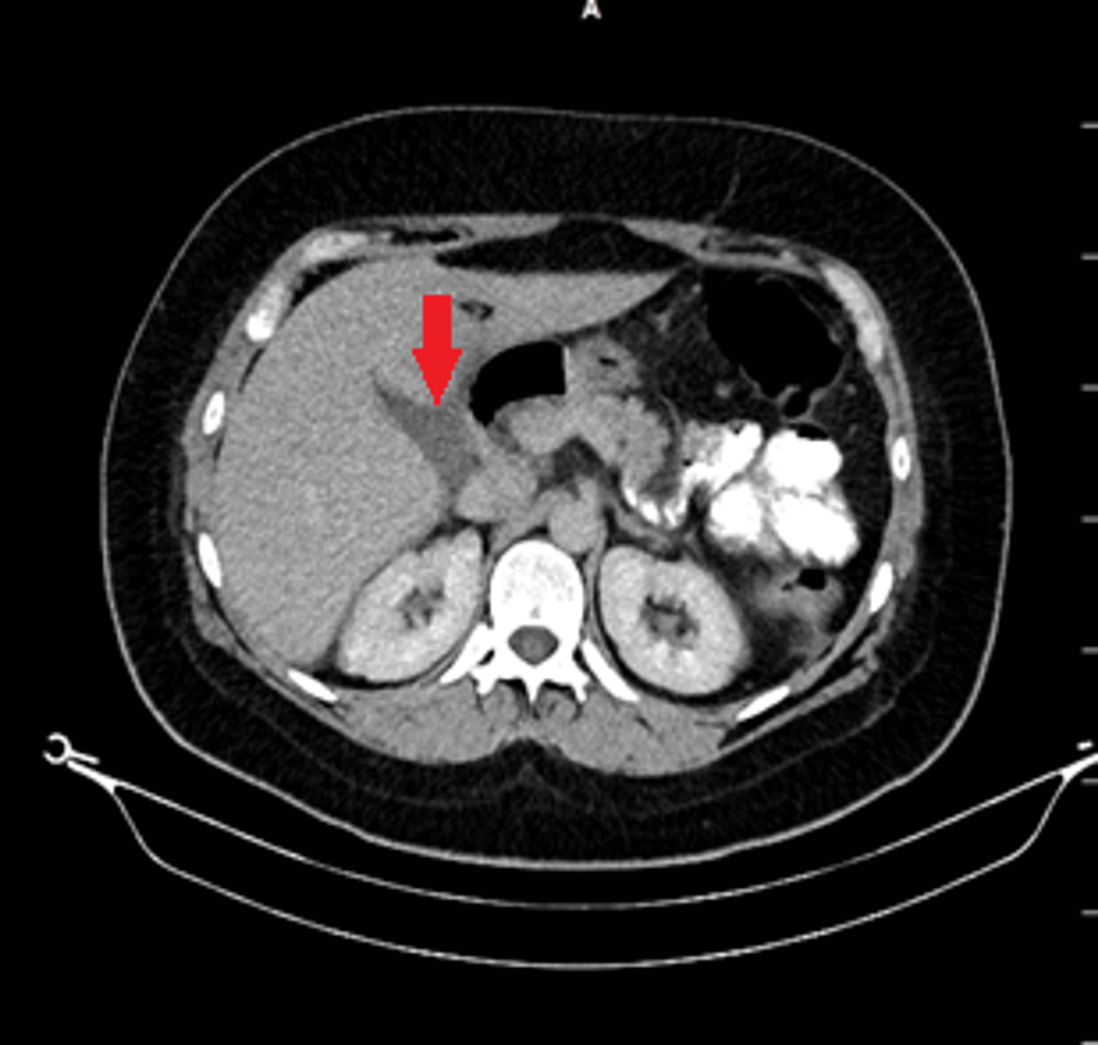 Cureus Bile Leakage From The Luschka Duct After Laparoscopic Sleeve 