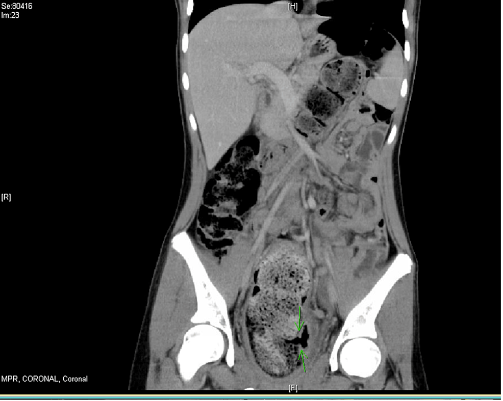 Fecal impaction, Radiology Reference Article