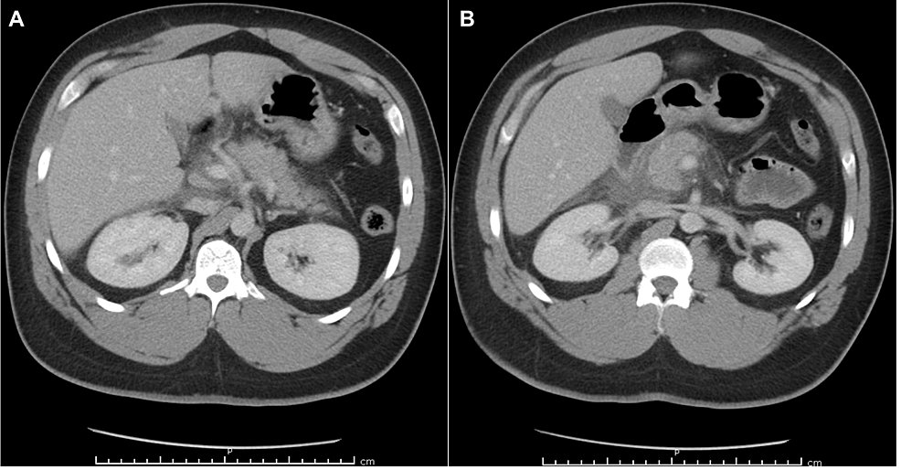 COVID-19, Hypertriglyceridemia, and Acute Pancreatitis: A Case Report ...