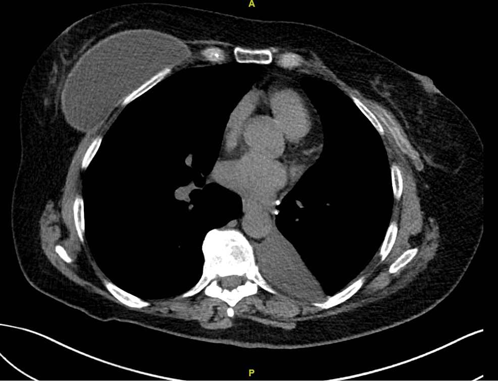 Iatrogenic Rupture of Saline Breast Implant Following RoboticAssisted