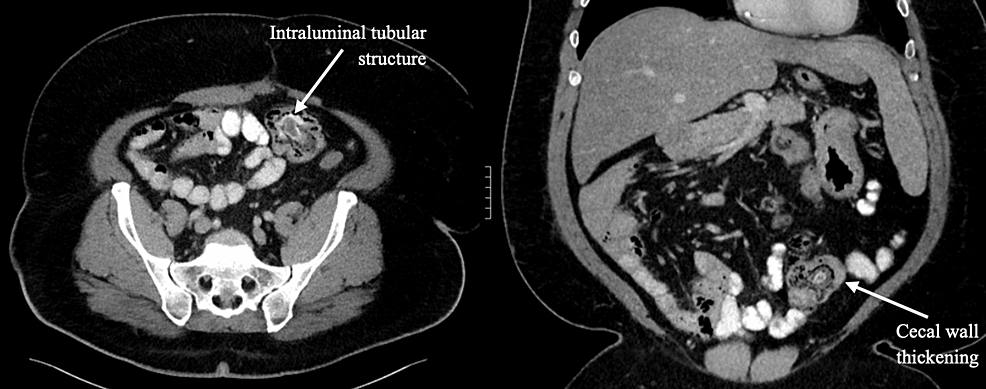 Cureus | Appendiceal Inversion Presenting as a Cecal Polypoid Mass on ...