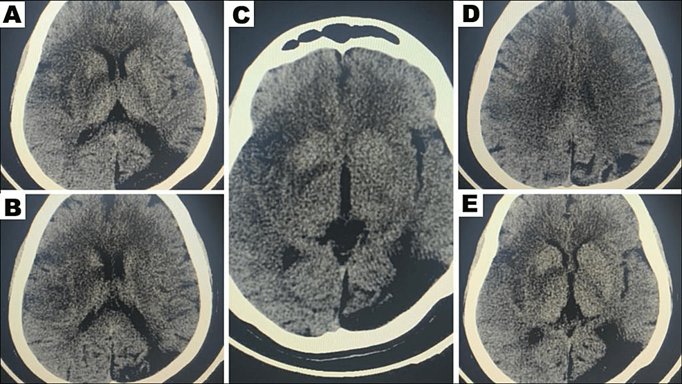 aspect-score-stroke-imaging-software-backed-by-research-from-rapidai