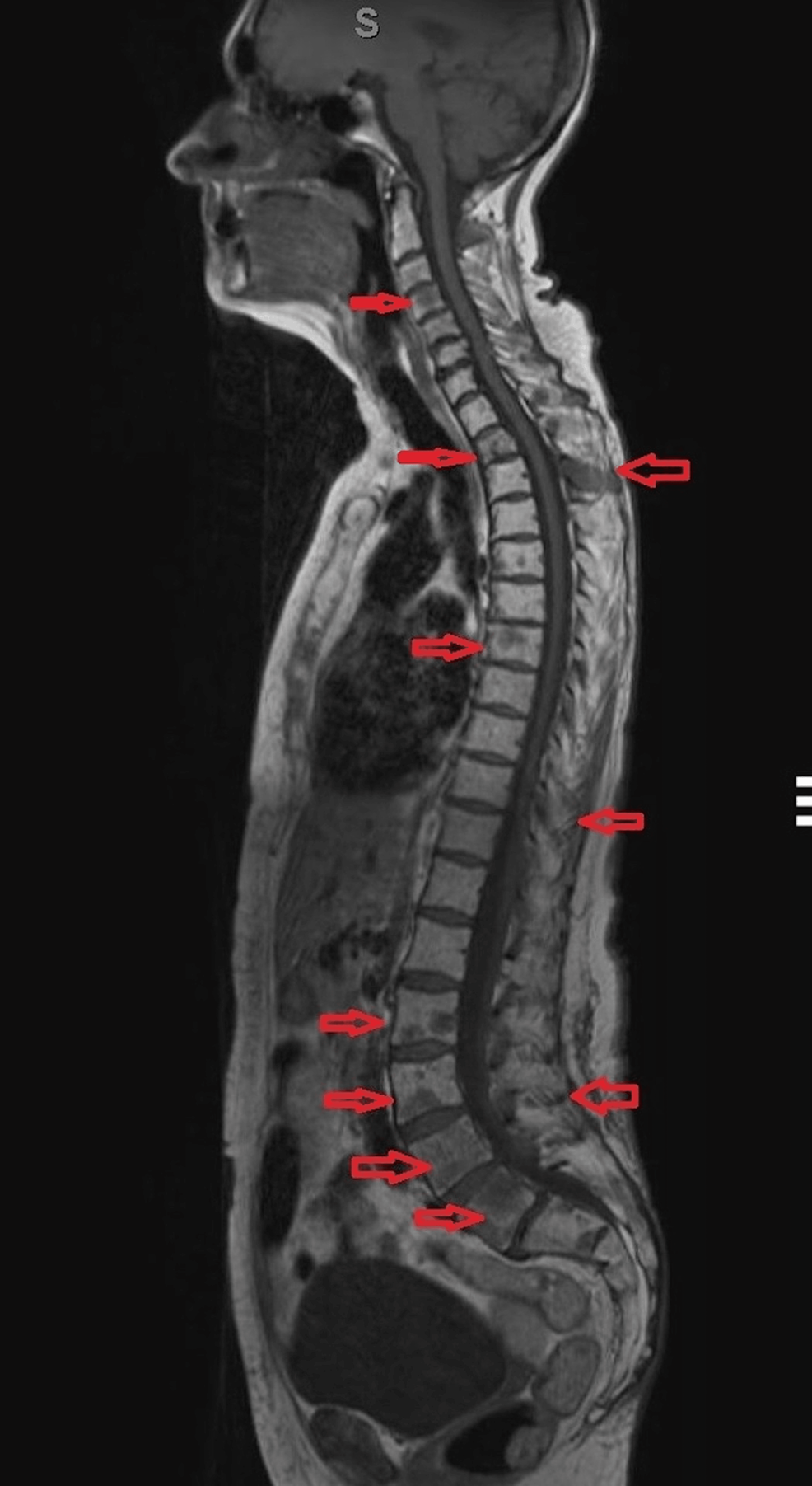 chemotherapy-may-obviate-prophylactic-femoral-nail-surgery-for-multiple