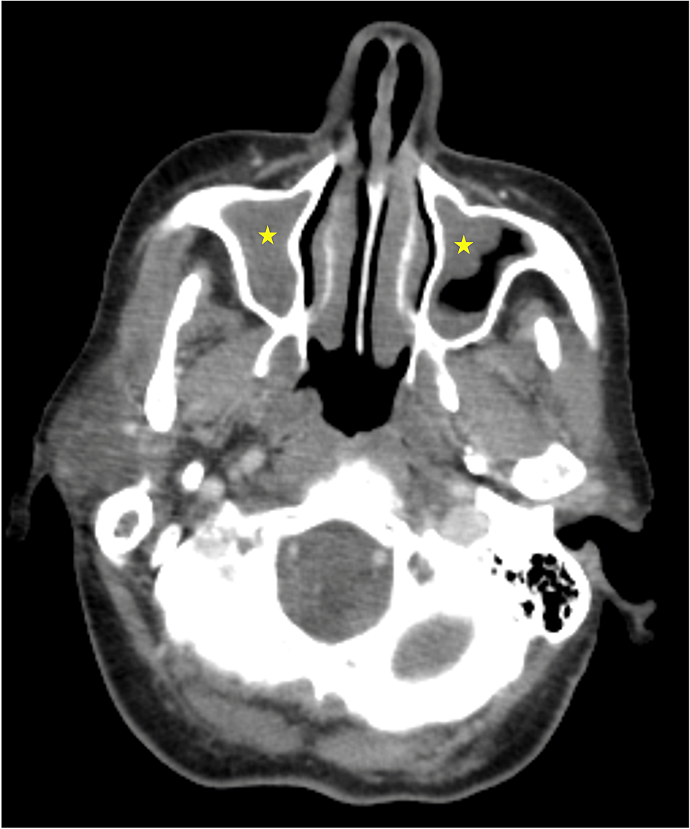 Cureus Sinusitis and LateOnset Asthma A Red Flag of Eosinophilic