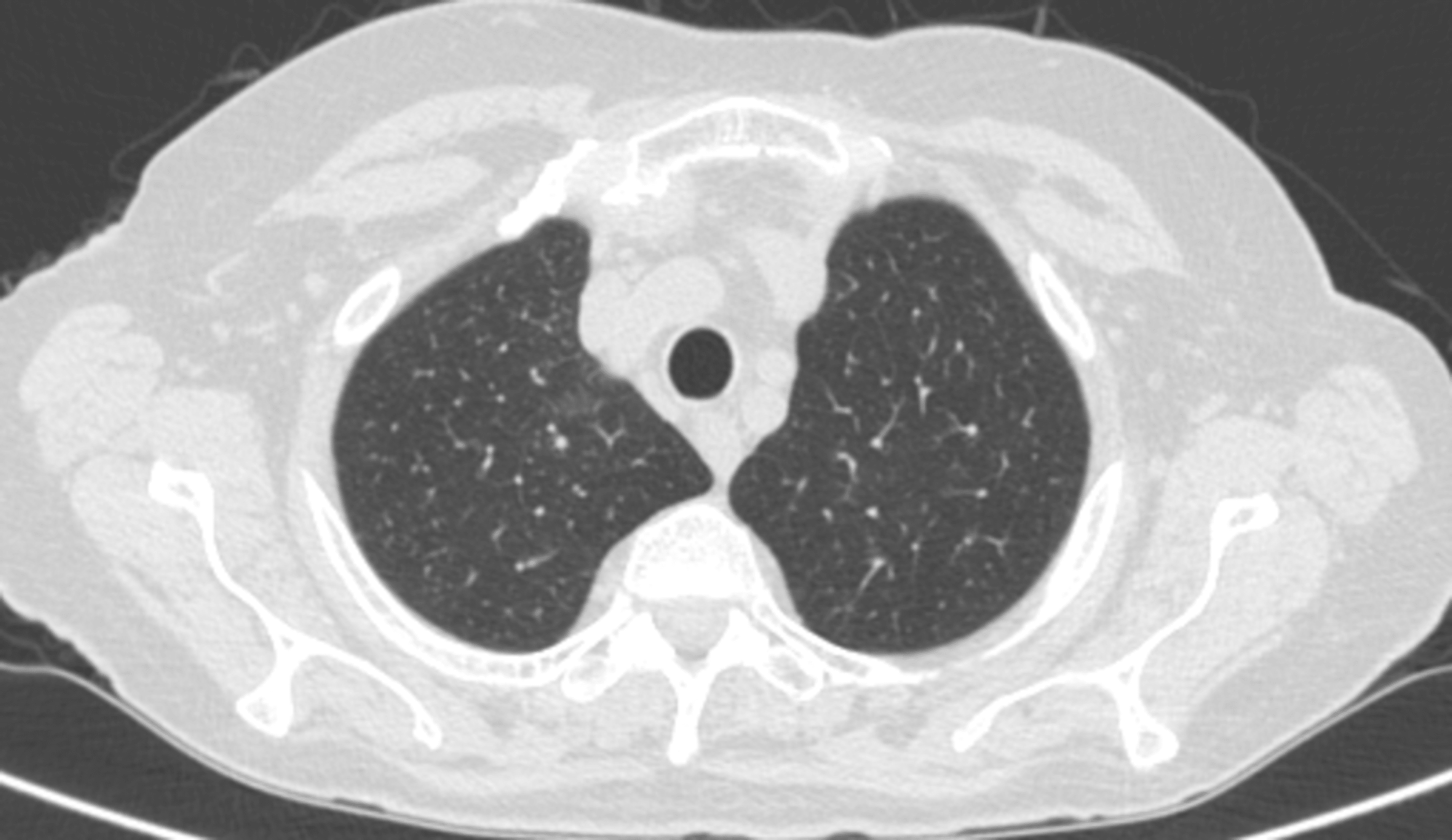 Sinusitis and LateOnset Asthma A Red Flag of Eosinophilic