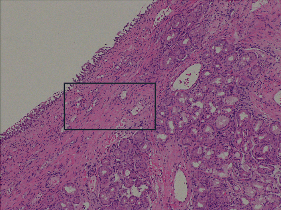 Sinusitis and LateOnset Asthma A Red Flag of Eosinophilic