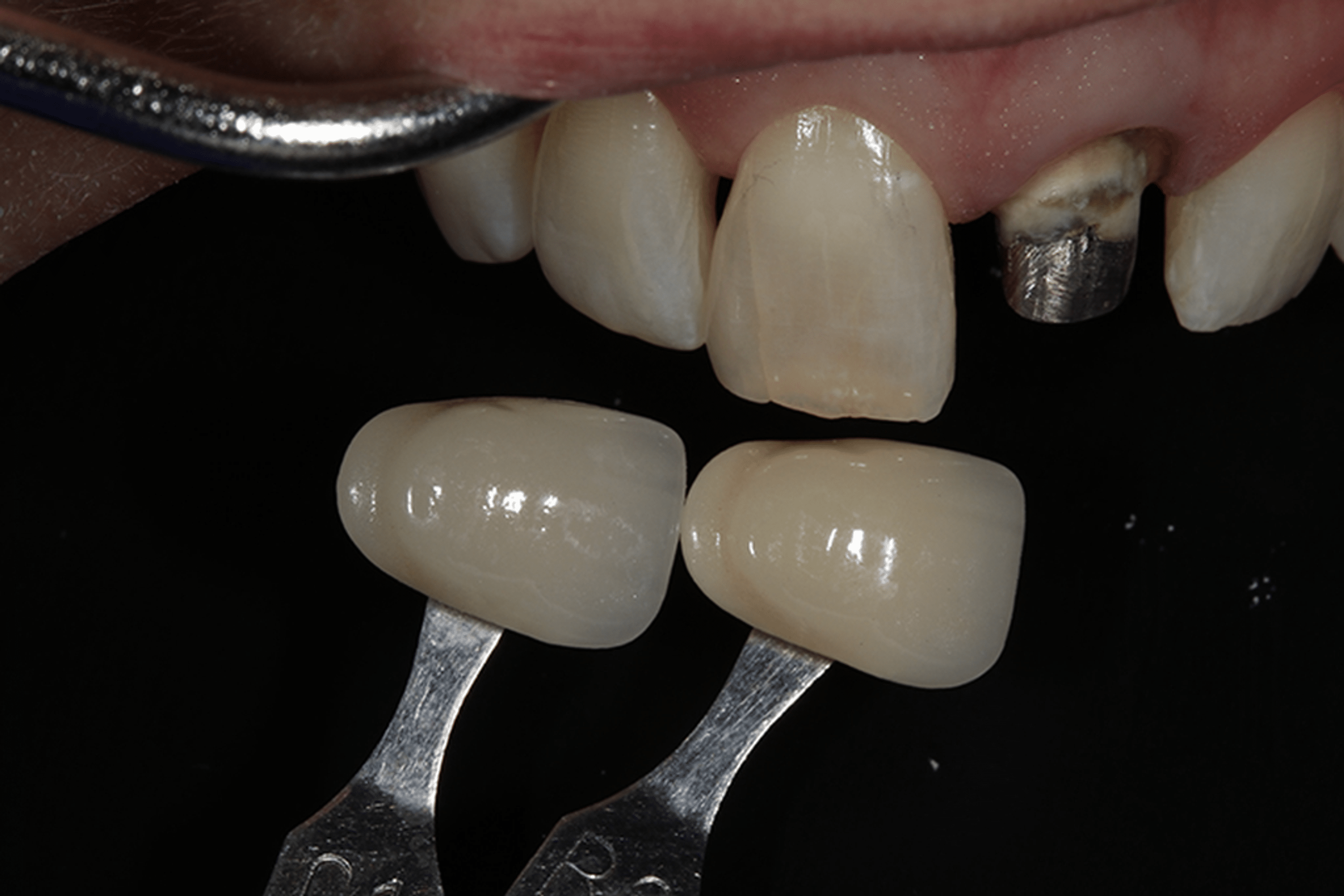 A Clinical Study Comparing the Maxillary Anterior Tooth Shade and