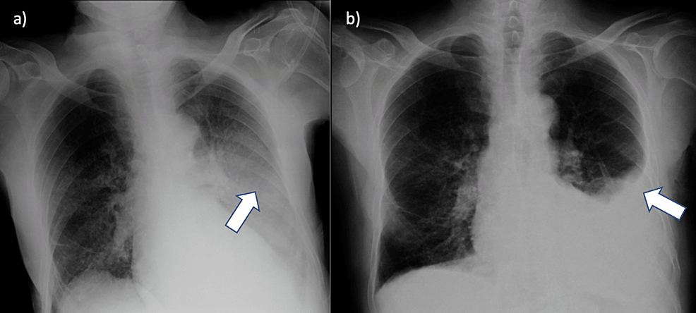 A Rare Geriatric Diagnosis of Eosinophilic Granulomatosis With ...