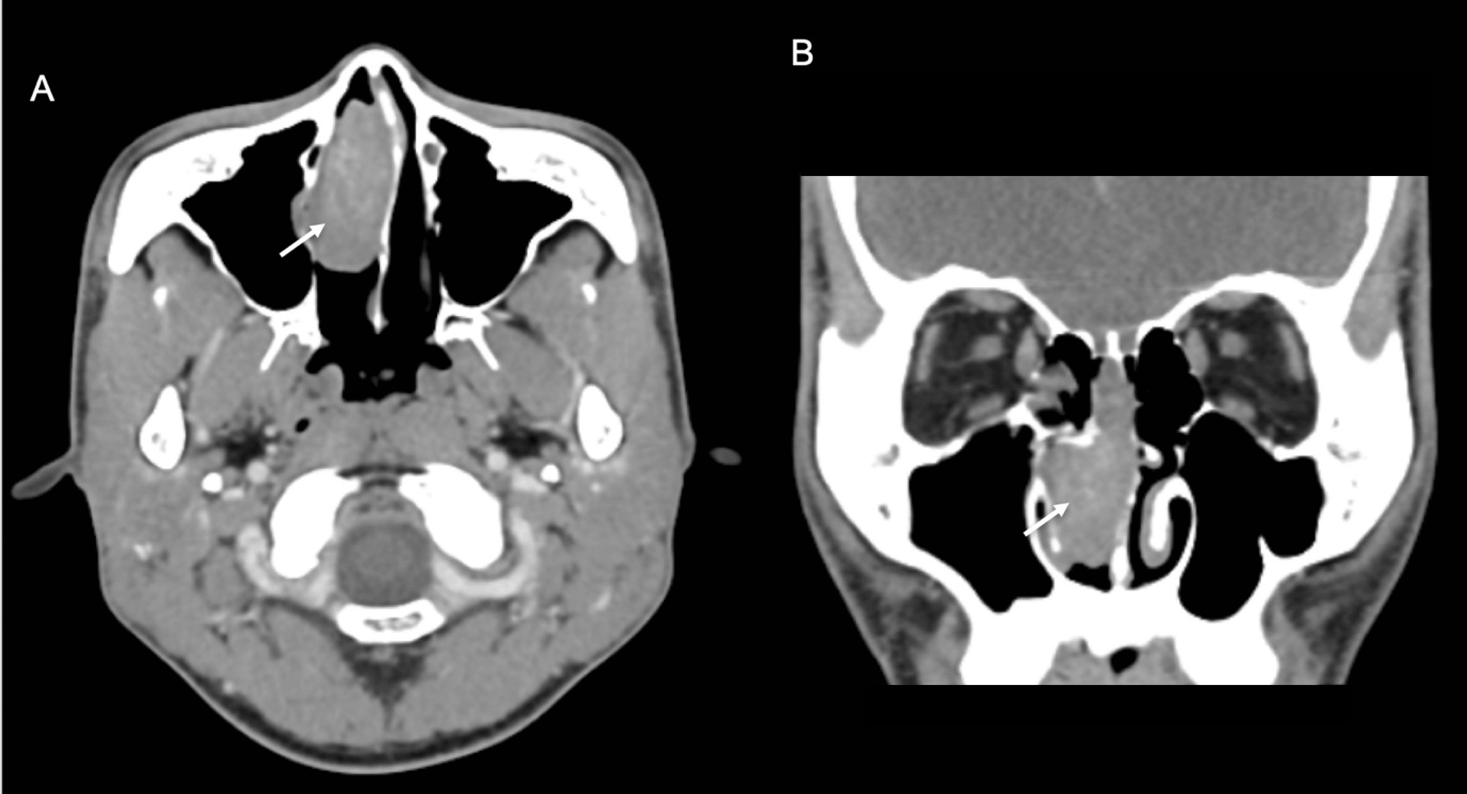 Cureus Solitary Fibrous Tumour A Rare Differential Diagnosis Of Unilateral Nasal Mass