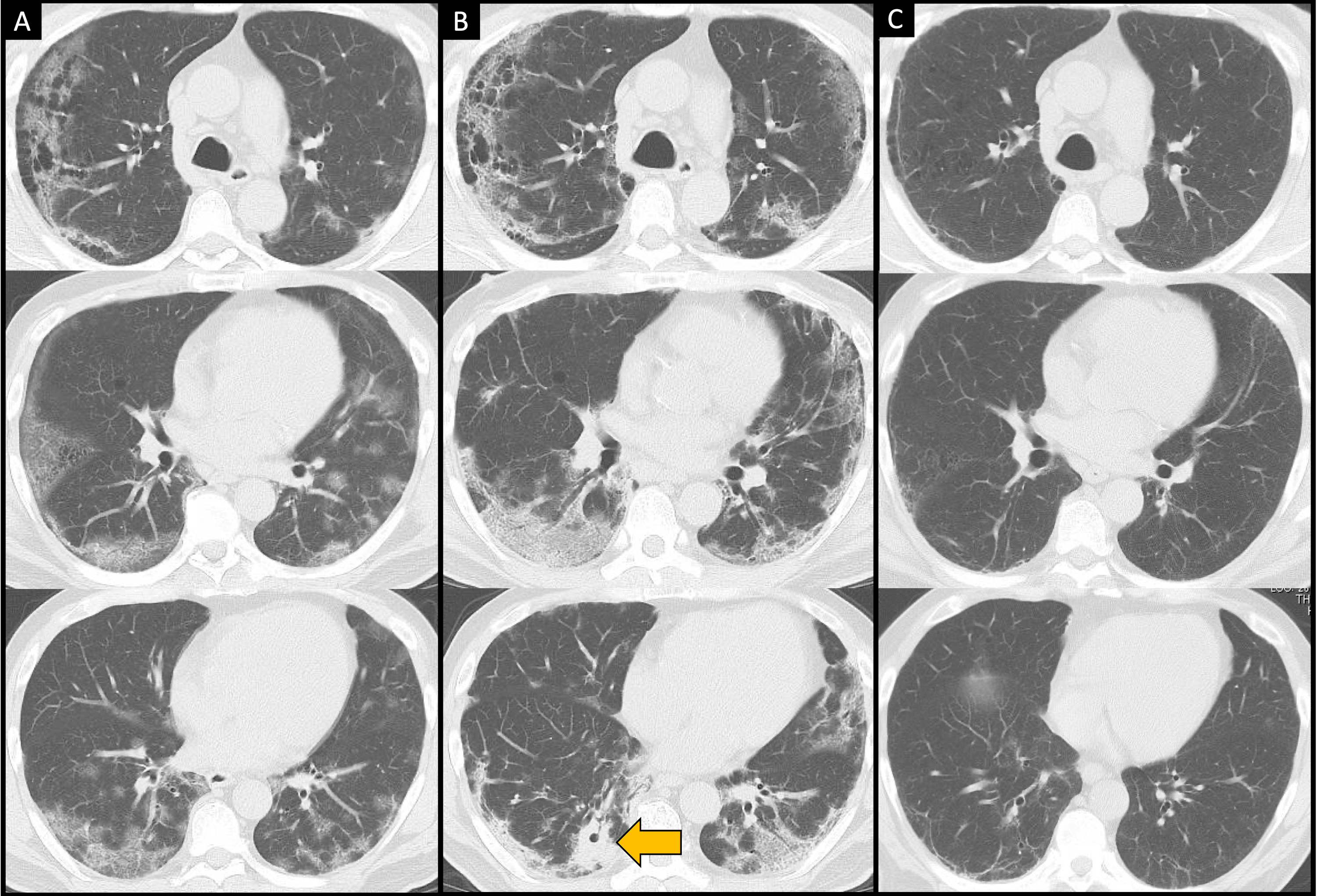 Cureus | COVID-19-Associated Pulmonary Aspergillosis Complicated By ...