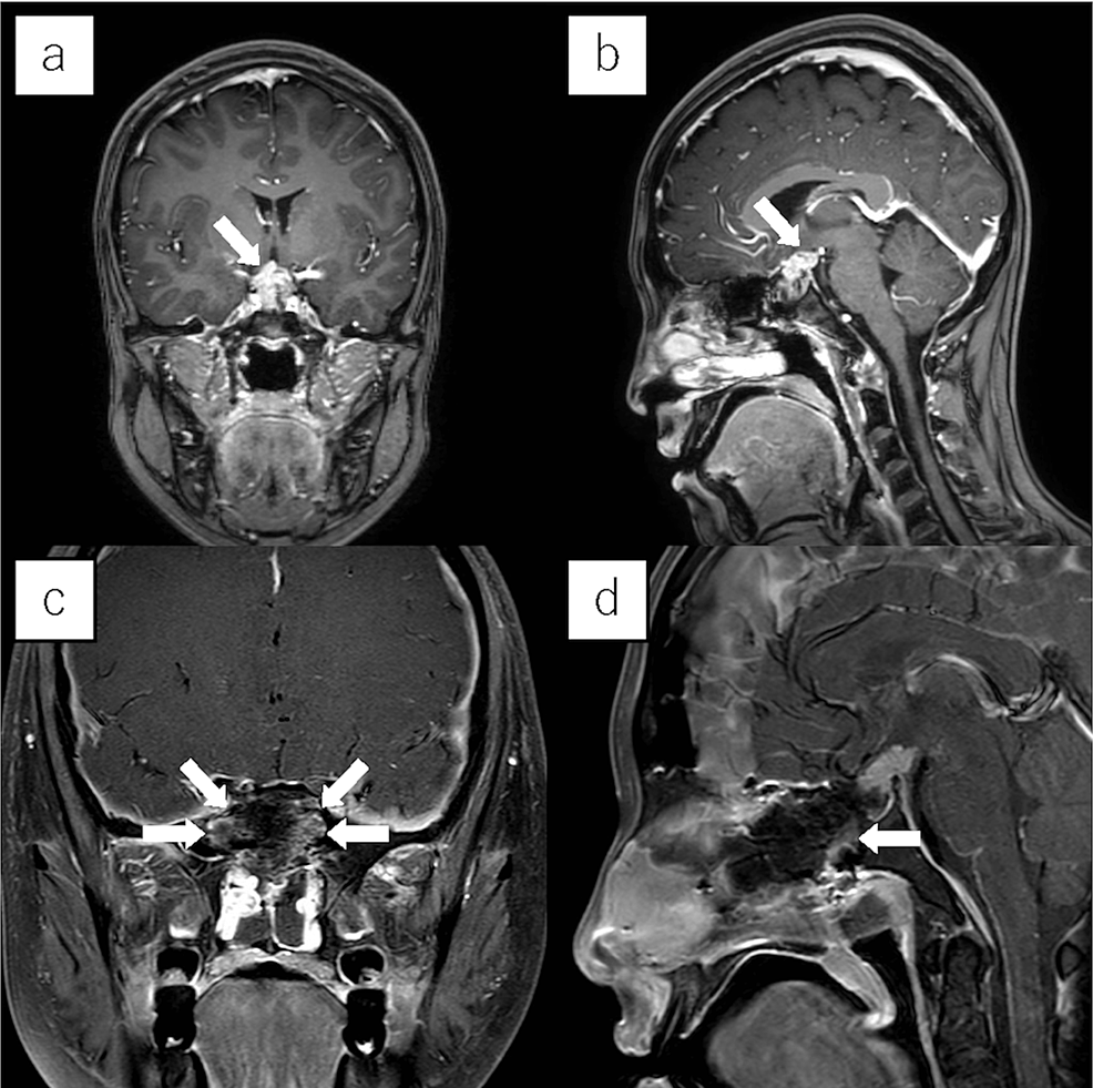 Cureus Takedown and Reuse of a Posterior Septal Nasal Floor Mucosal