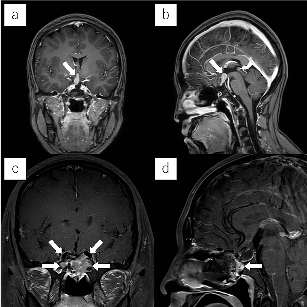 Takedown and Reuse of a Posterior Septal Nasal Floor Mucosal Flap for