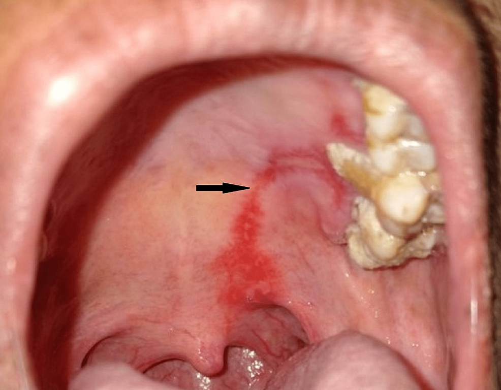 Cureus Management of a Large Palatal Ulcer Mucous Membrane Pemphigoid