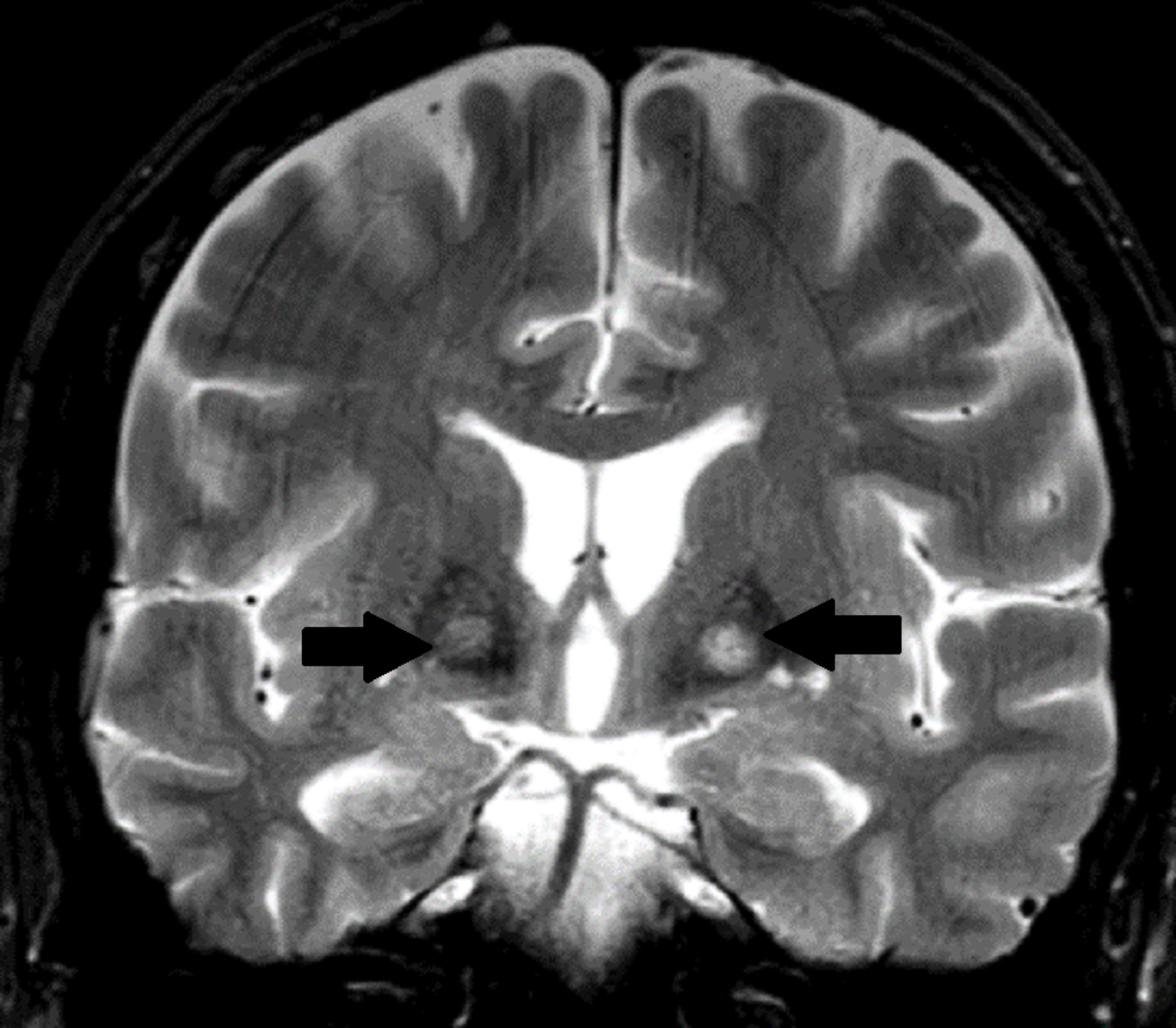 Cureus Eye Of The Tiger Sign In Neurodegeneration With Brain Iron Accumulation