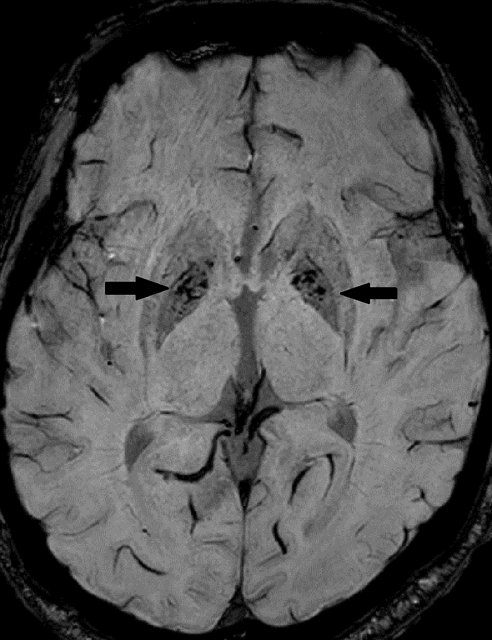 Cureus Eye Of The Tiger Sign In Neurodegeneration With Brain Iron Accumulation