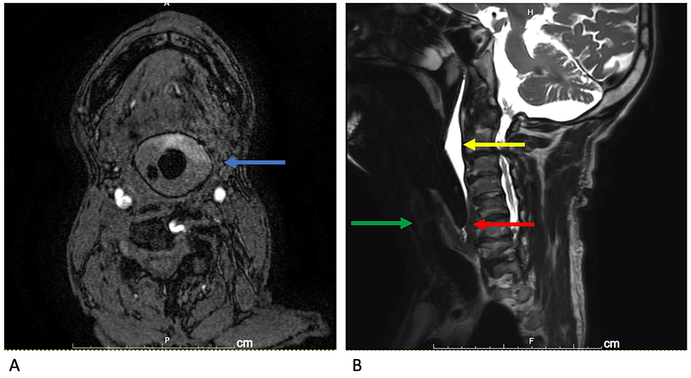 Noninvasive Blood Pressure System for MRI, NIBP-B-MRI, Research