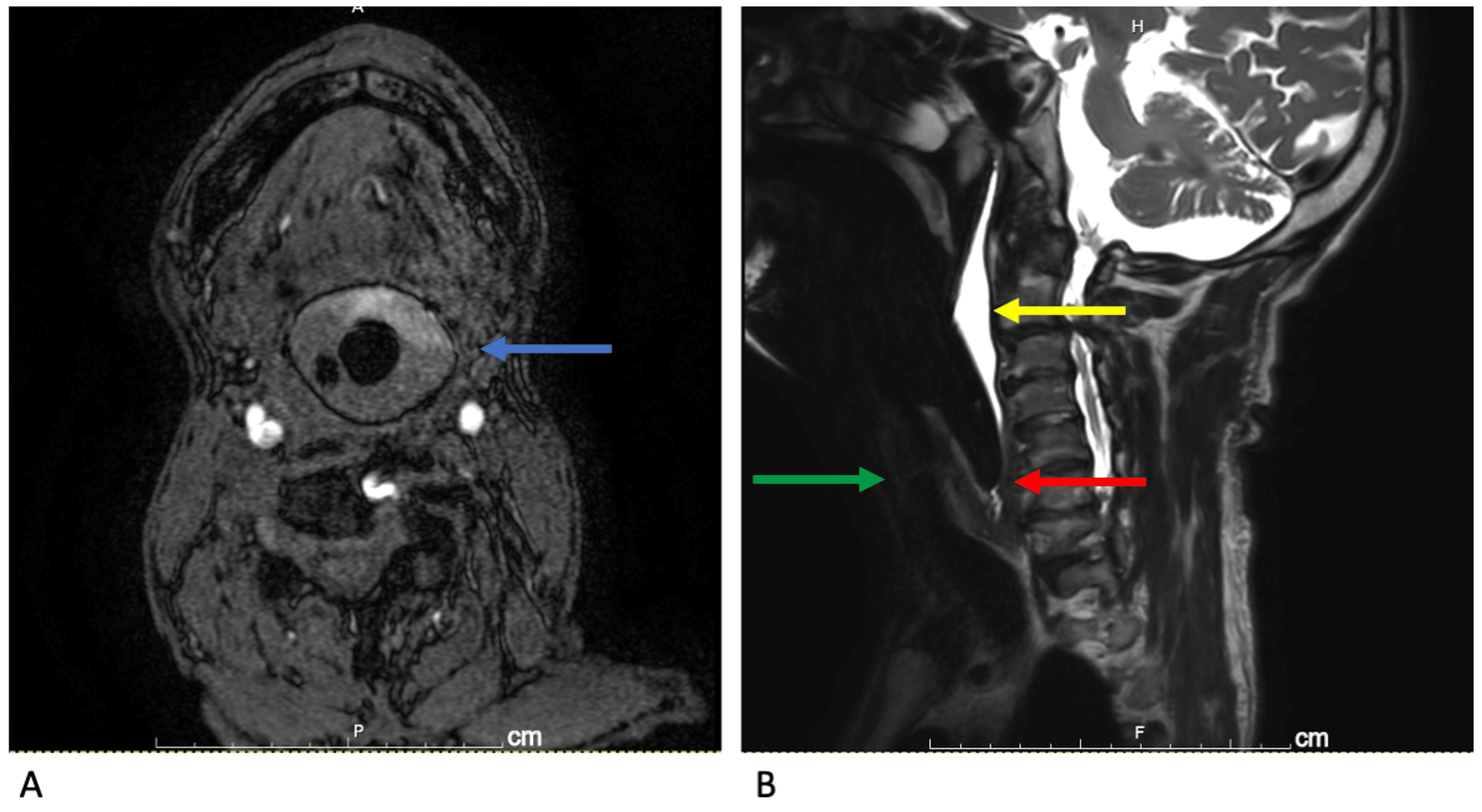 Cureus A Case of General Anaesthesia Using an Igel Airway for MRI of
