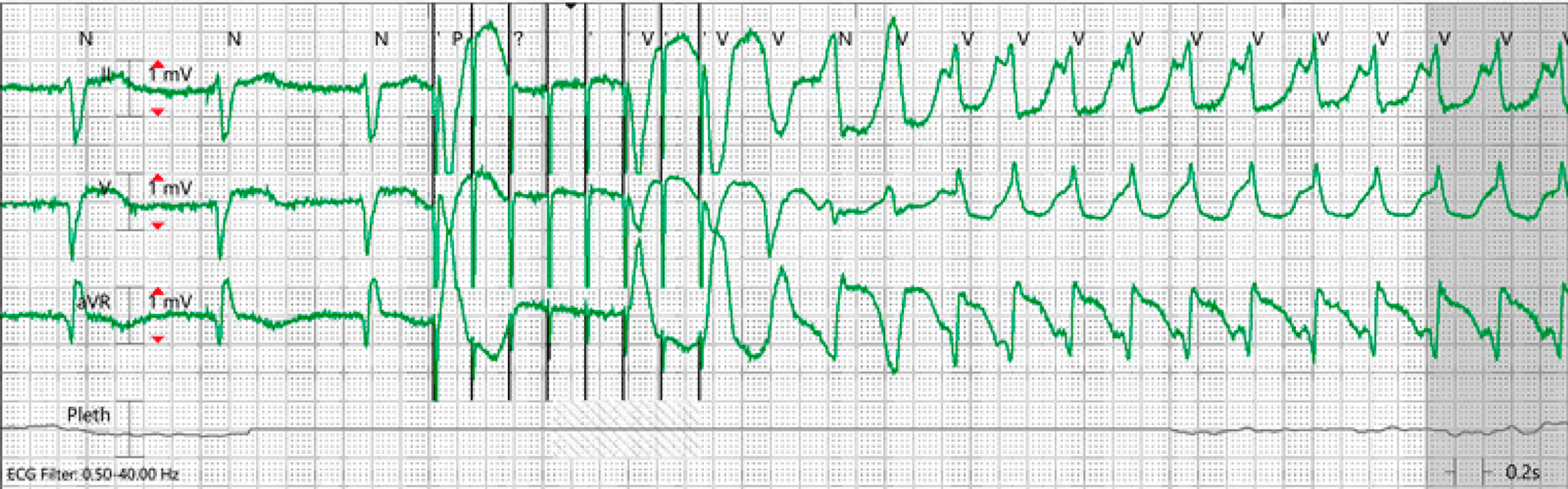 Cureus A Case of 25 Inappropriate Automatic Implantable Cardioverter