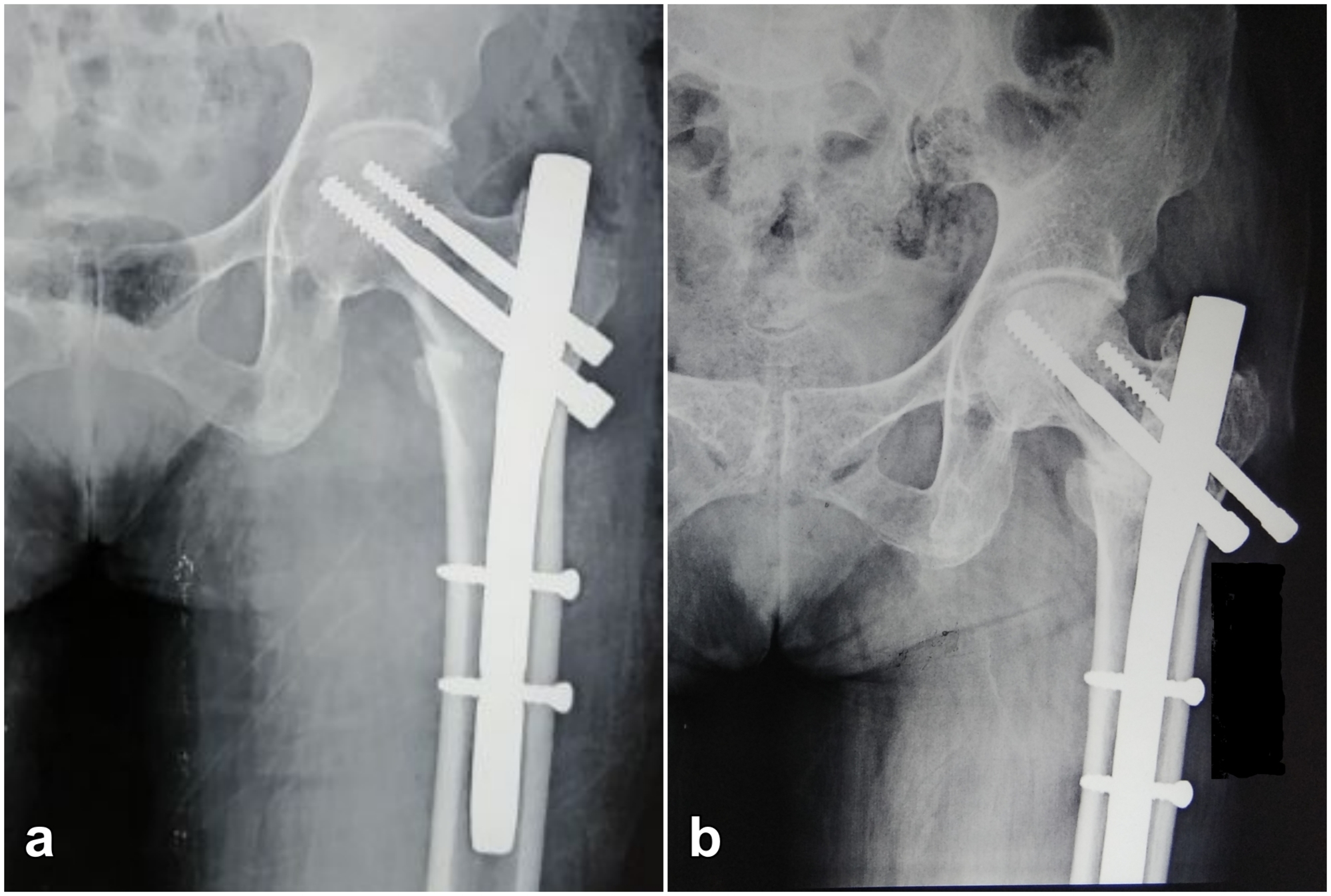 Cureus | Surgical Treatment of Type 31-A1 Two-part Intertrochanteric Femur  Fractures: Is Proximal Femoral Nail Superior to Dynamic Hip Screw Fixation?  | Article