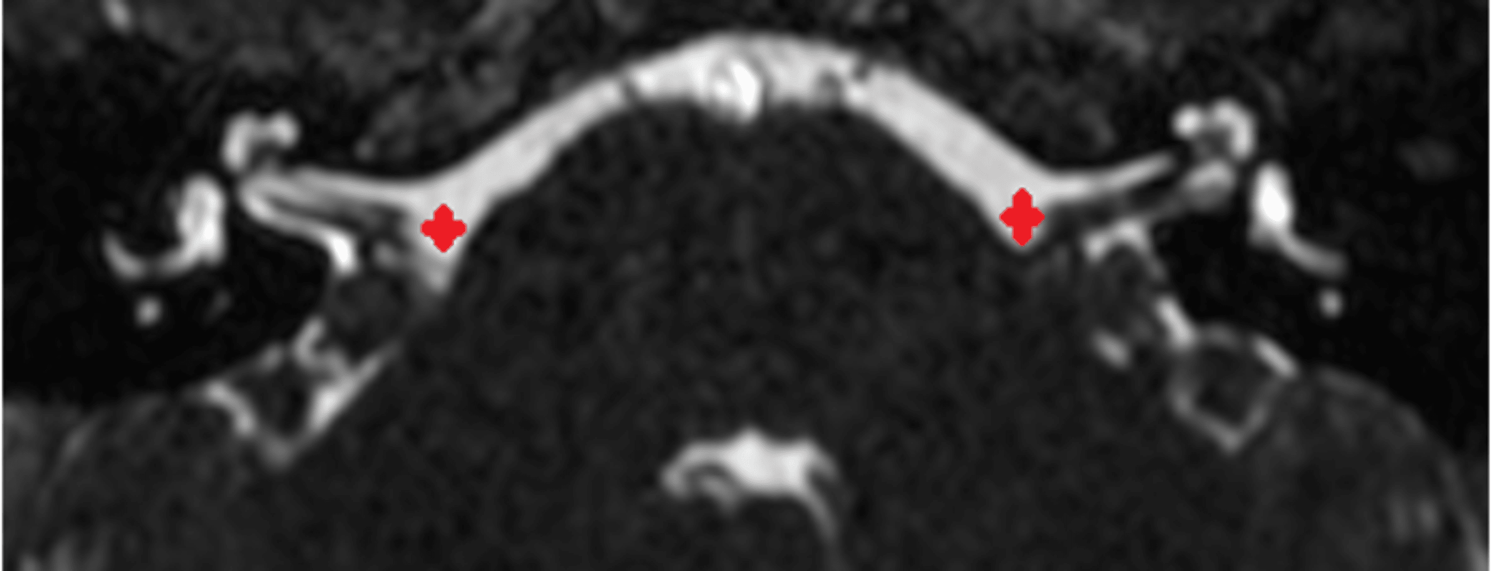 Cochlear Implant After Sudden Onset Sensorineural Hearing Loss A Case