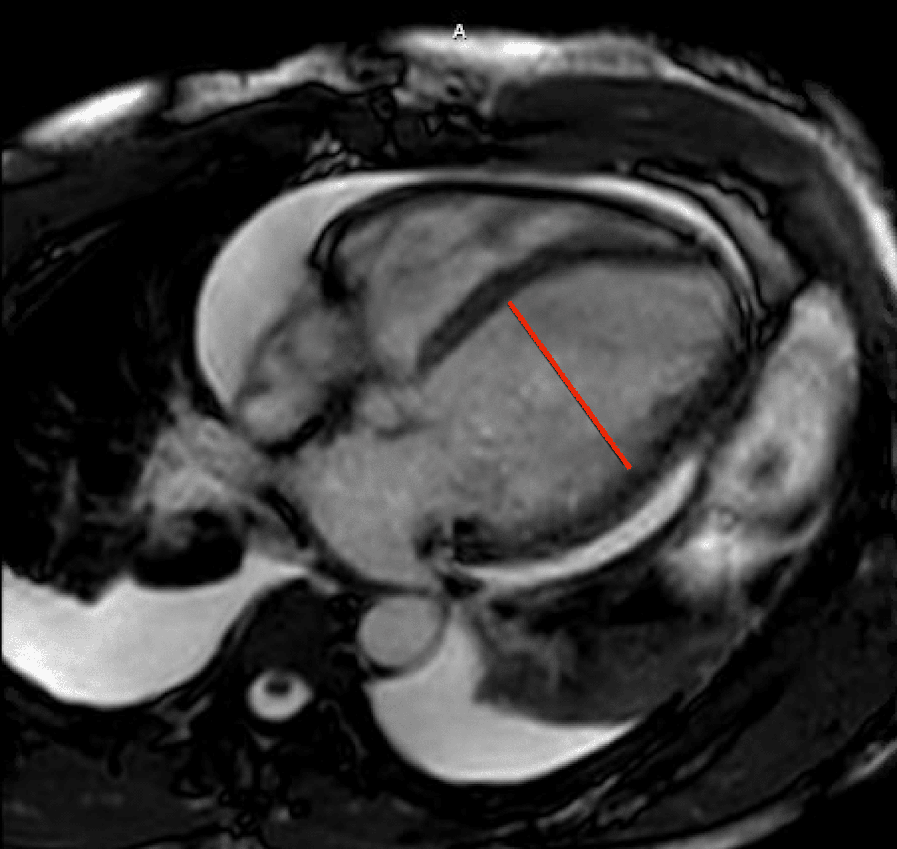 Dilated Cardiomyopathy As A Result Of Coxsackie B Virus Myocarditis ...