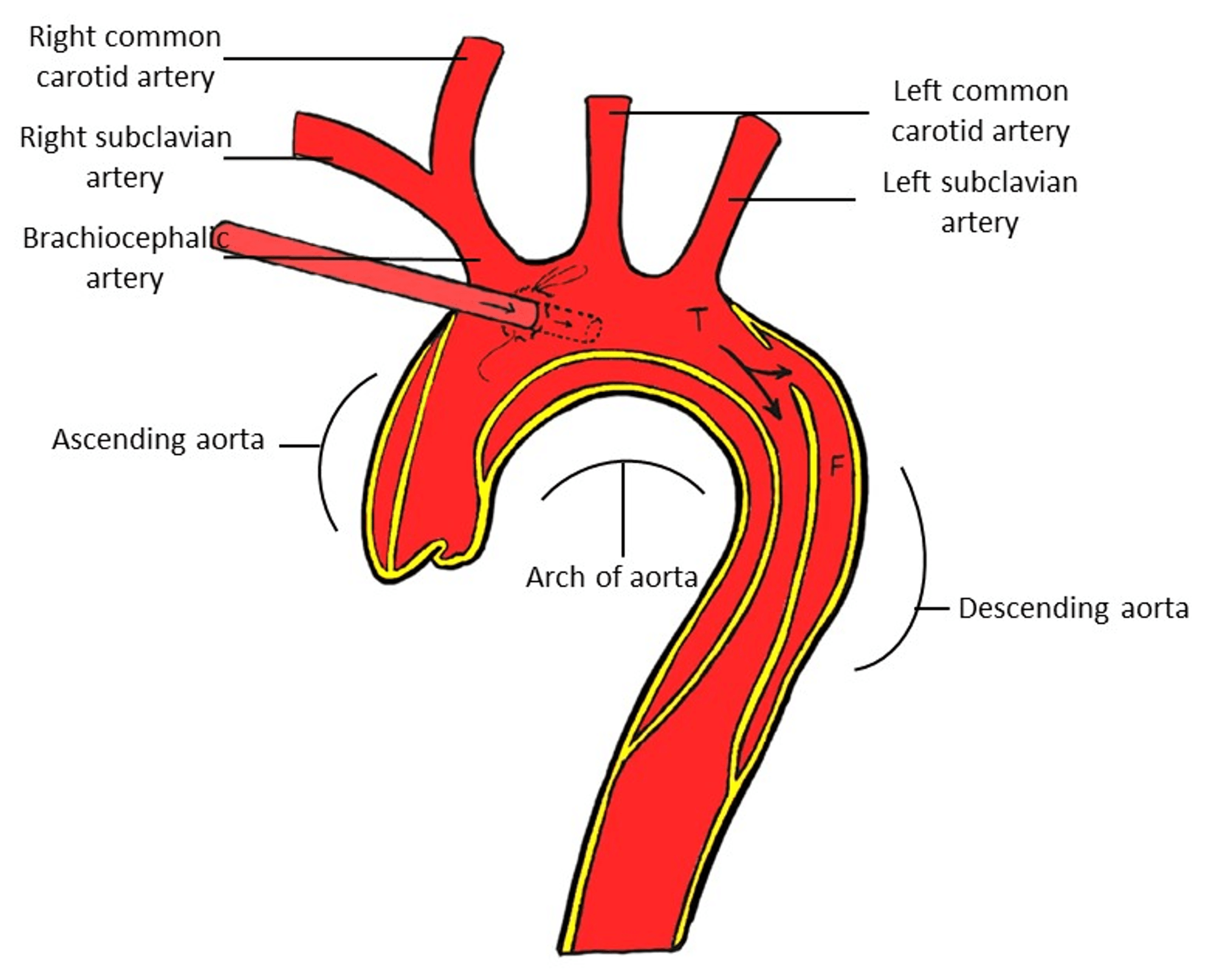 Clinical Application of Proximal Arch Cannulation in the Surgical