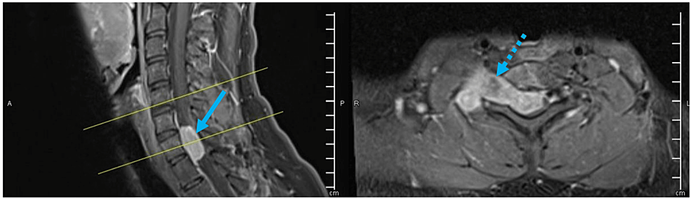 Cureus, Tuberculosis of the Cervical Spine: A Case Report