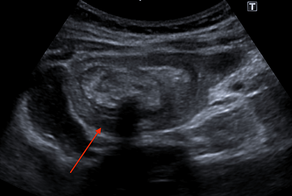 Cureus | All Tangled Up: Meter-Long Gastric Trichobezoar Causing ...