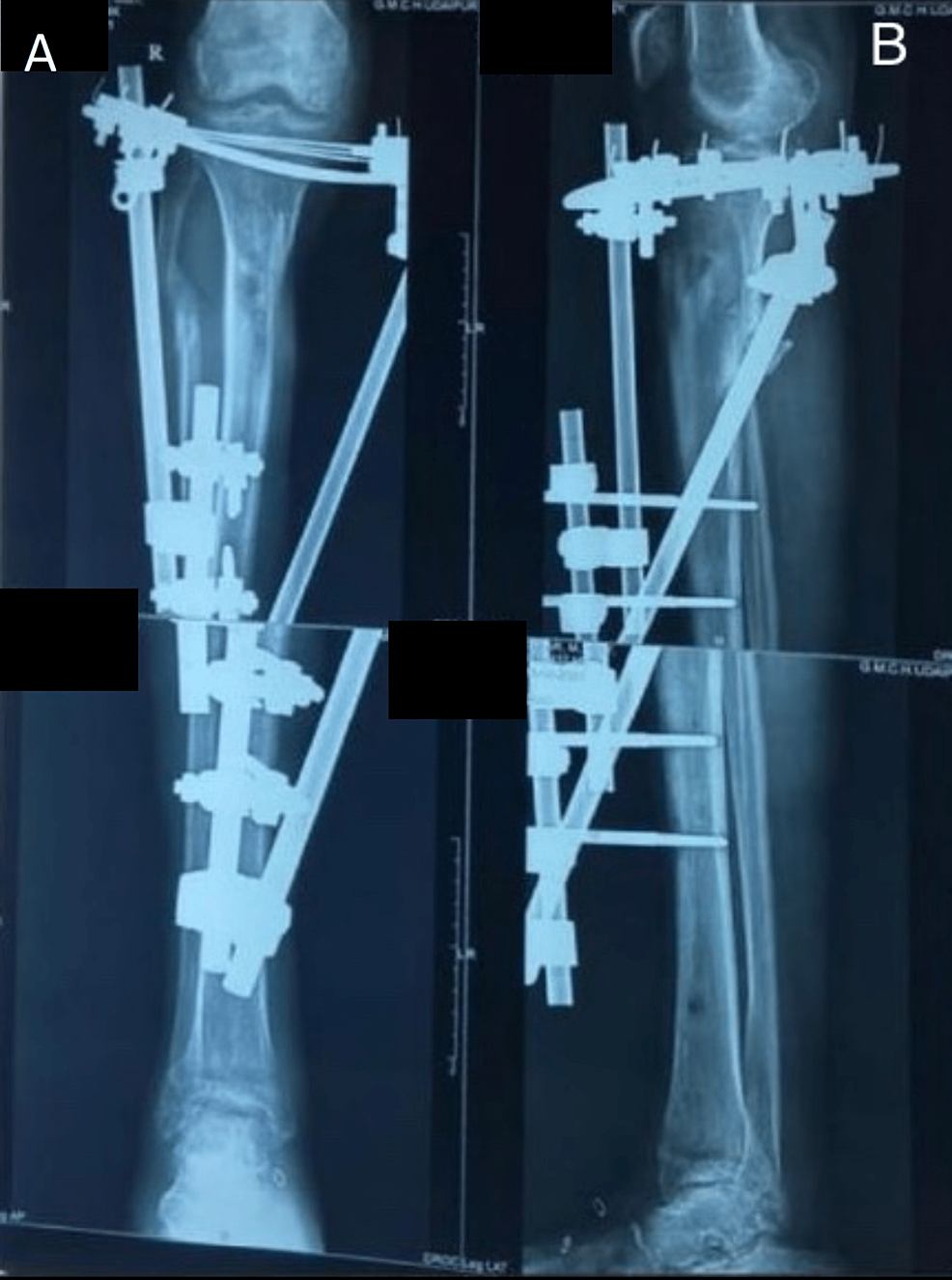 Cureus Bridge Plating Versus Hybrid External Fixation In The