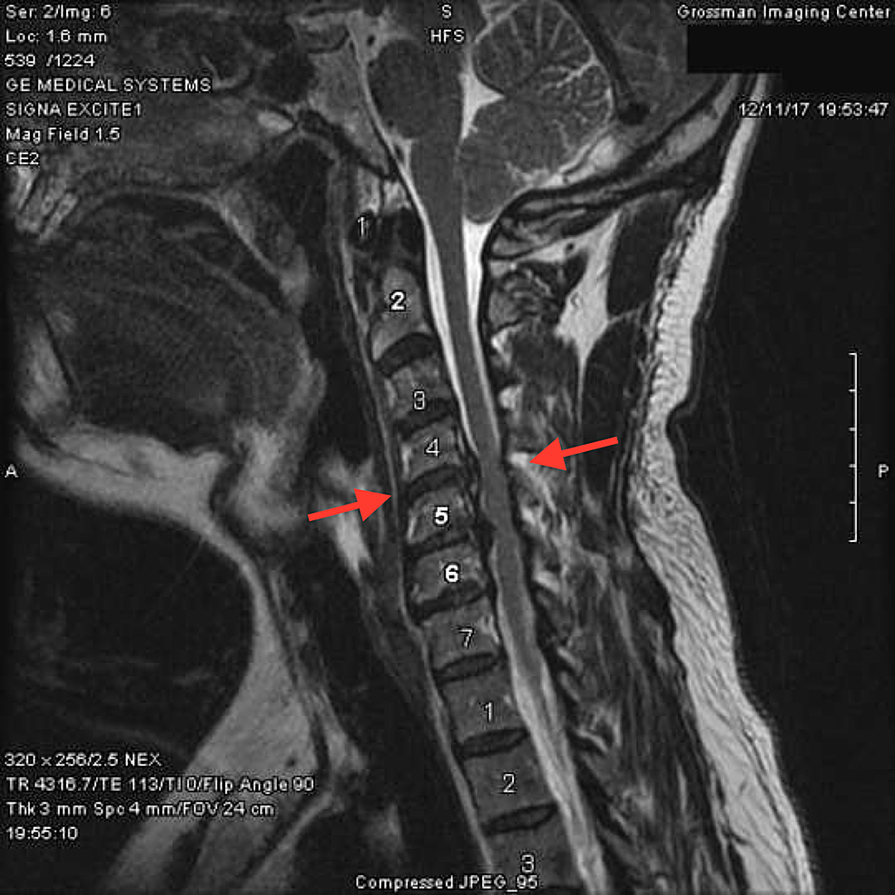 cureus-a-novel-3d-printed-titanium-implant-for-anterior-cervical