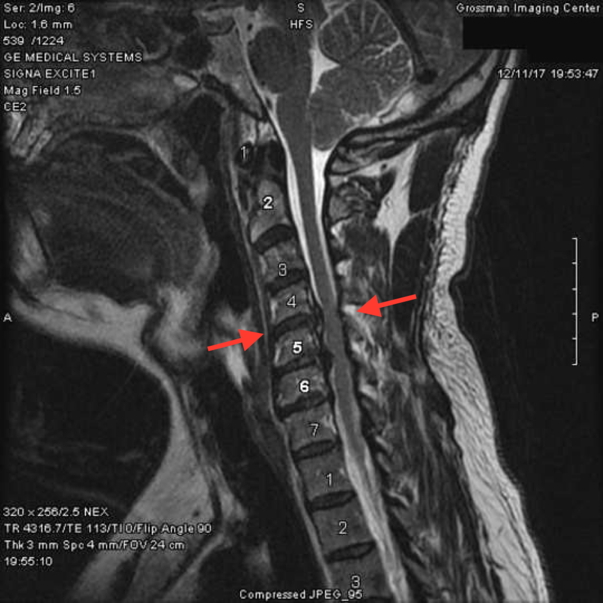 Cervical Spondylosis Mri Images