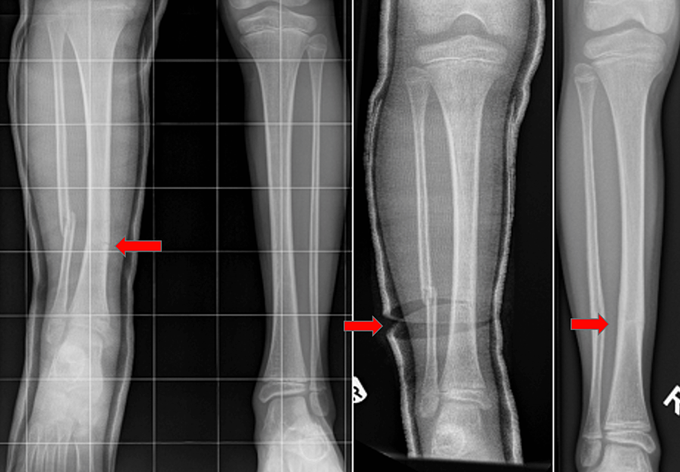 Cureus Tibia Fractures in Children A SingleCentre 11Year