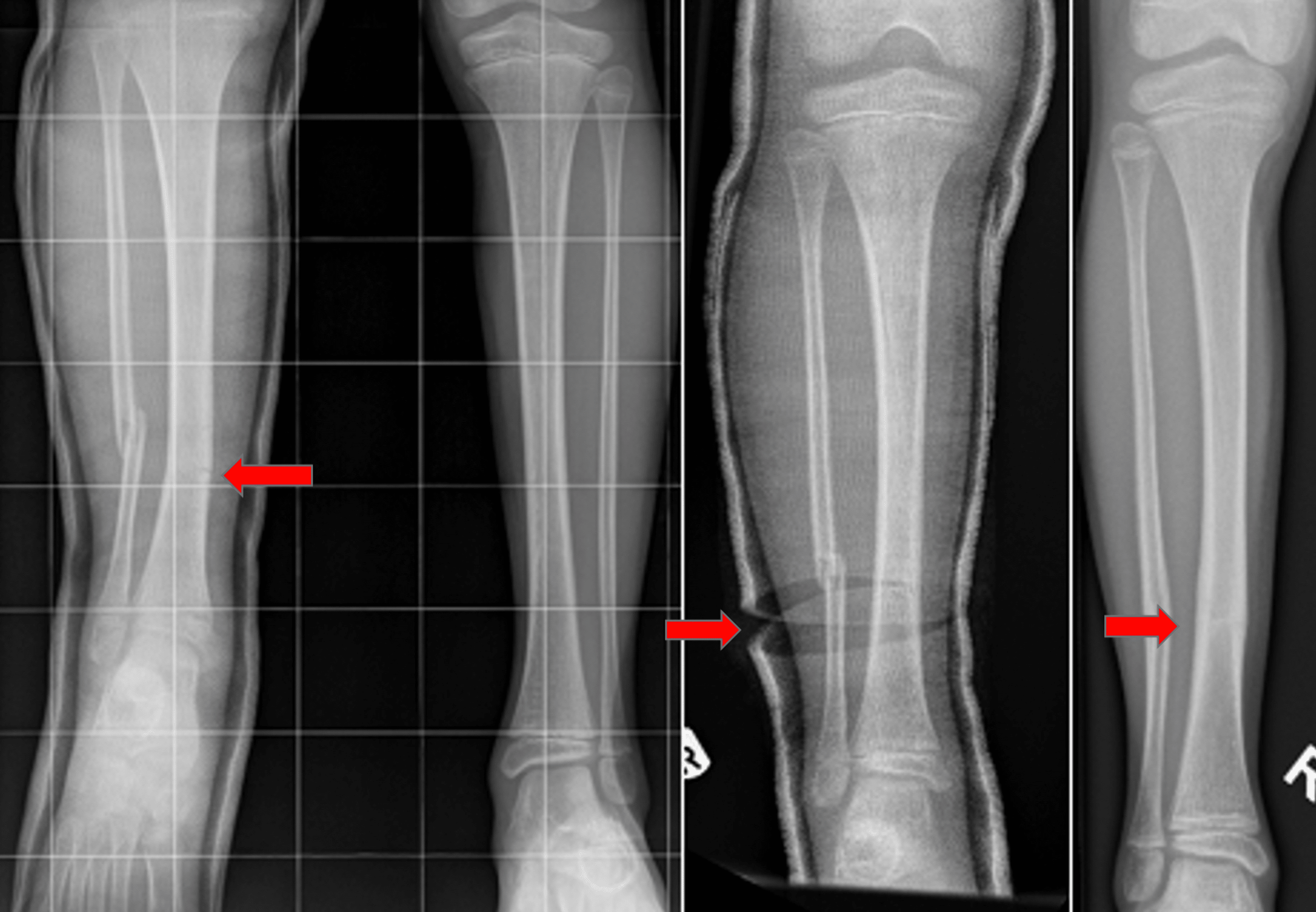 cureus-tibia-fractures-in-children-a-single-centre-11-year