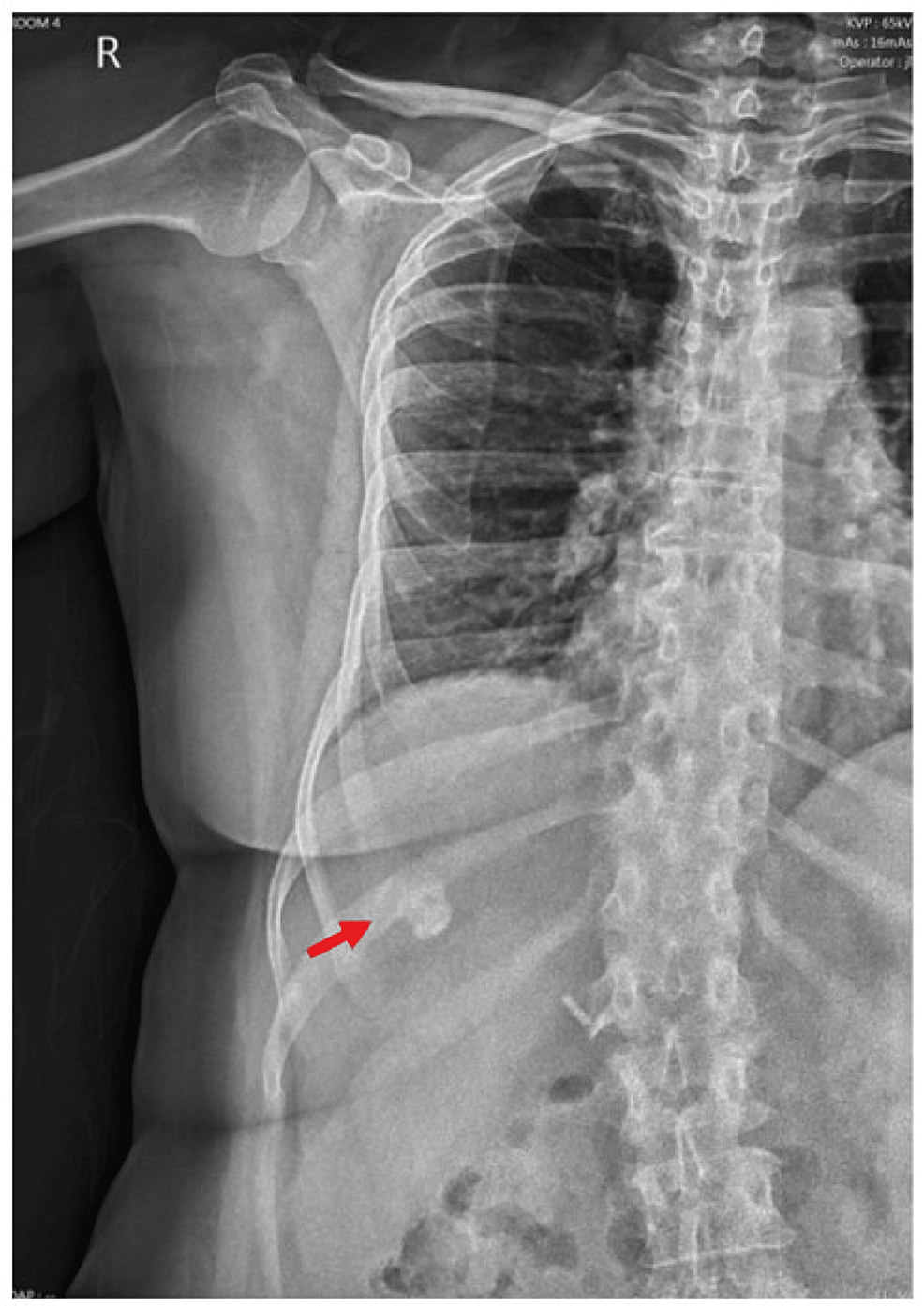 Cureus Hepatic Dystrophic Calcification Secondary to Transarterial